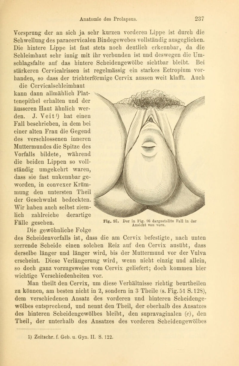 <rv£^- Vorsprung der an sich ja sehr kurzen vorderen Lippe ist durch die Schwellung des paracervicalen Bindegewebes vollständig ausgeglichen. Die hintere Lippe ist fast stets noch deutlich erkennbar, da die Schleimhaut sehr innig mit ihr verbunden ist und deswegen die Um- schlagsfalte auf das hintere Scheidengewölbe sichtbar bleibt. Bei stärkeren Cervicalrissen ist regelmässig ein starkes Ectropium vor- handen, so dass der trichterförmige Cervix aussen weit klafft. Auch die Cervicalschleimhaut kann dann allmählich Plat- tenepithel erhalten und der äusseren Haut ähnlich wer- den. J. Veit1) hat einen Fall beschrieben, in dem bei einer alten Frau die Gegend des verschlossenen inneren Muttermundes die Spitze des Vorfalls bildete, während die beiden Lippen so voll- ständig umgekehrt waren, dass sie fast unkennbar ge- worden, in convexer Krüm- mung den untersten Theil der Geschwulst bedeckten. Wir haben auch selbst ziem- lich zahlreiche Fälle gesehen. Die gewöhnliche Folge des Scheidenvorfalls ist, dass die am Cervix befestigte, nach unten zerrende Scheide einen solchen Reiz auf den Cervix ausübt, dass derselbe länger und länger wird, bis der Muttermund vor der Vulva erscheint. Diese Verlängerung wird, wenn nicht einzig und allein, so doch ganz vorzugsweise vom Cervix geliefert; doch kommen hier wichtige Verschiedenheiten vor. Man theilt den Cervix, um diese Verhältnisse richtig beurtheilen zu können, am besten nicht in 2, sondern in 3 Theile (s. Fig. 51 S. 128), dem verschiedenen Ansatz des vorderen und hinteren Scheidenge- wölbes entsprechend, und nennt den Theil, der oberhalb des Ansatzes des hinteren Scheidengewölbes bleibt, den supravaginalen (c), den Theil, der unterhalb des Ansatzes des vorderen Scheidengewölbes derartige Fig. 97. Der in Fig. 96 dargestellte Fall in der Ansicht von vorn. 1) Zeitschr. f. Geb. u. Gyn. IL S. 122.