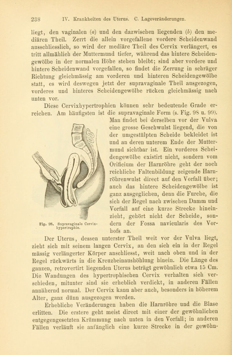 liegt, den vaginalen (ä) und den dazwischen liegenden (b) den me- diären Theil. Zerrt die allein vorgefallene vordere Scheidenwand ausschliesslich, so wird der mediäre Theil des Cervix verlängert, es tritt allmählich der Muttermund tiefer, während das hintere Scheiden- gewölbe in der normalen Höhe stehen bleibt; sind aber vordere und hintere Scheidenwand vorgefallen, so findet die Zerrung in schräger Richtung gleichmässig am vorderen und hinteren Scheidengewölbe statt, es wird deswegen jetzt der supravaginale Theil ausgezogen, vorderes und hinteres Scheidengewölbe rücken gleichmässig nach unten vor. Diese Cervixhypertrophien können sehr bedeutende Grade er- reichen. Am häufigsten ist die supravaginale Form (s. Fig. 98 u. 99). Man findet bei derselben vor der Vulva eine grosse Geschwulst liegend, die von der umgestülpten Scheide bekleidet ist und an deren unterem Ende der Mutter- mund sichtbar ist. Ein vorderes Schei- dengewölbe existirt nicht, sondern vom Orificium der Harnröhre geht der noch reichliche Faltenbildung zeigende Harn- röhrenwulst direct auf den Vorfall über; auch das hintere Scheidengewölbe ist ganz ausgeglichen, denn die Furche, die sich der Regel nach zwischen Damm und Vorfall auf eine kurze Strecke hinein- zieht, gehört nicht der Scheide, son- Fig. 9S. Supravaginale Cerrix- dem der FoSSa naviculai'is des Vor- hypertrophie. , „ hofs an. Der Uterus, dessen unterster Theil weit vor der Vulva liegt, zieht sich mit seinem langen Cervix, an den sich ein in der Regel massig verlängerter Körper anschliesst, weit nach oben und in der Regel rückwärts in die Kreuzbeinaushöhlung hinein. Die Länge des ganzen, retrovertirt liegenden Uterus beträgt gewöhnlich etwa 15 Cm. Die Wandungen des hypertrophischen Cervix verhalten sich ver- schieden, mitunter sind sie erheblich verdickt, in anderen Fällen annähernd normal. Der Cervix kann aber auch, besonders in höherem Alter, ganz dünn ausgezogen werden. Erhebliche Veränderungen haben die Harnröhre und die Blase erlitten. Die erstere geht meist direct mit einer der gewöhnlichen entgegengesetzten Krümmung nach unten in den Vorfall; in anderen Fällen verläuft sie anfänglich eine kurze Strecke in der gewöhn-
