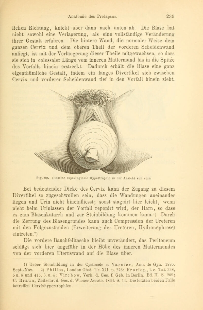 lieben Richtung, knickt aber dann nach unten ab. Die Blase hat nicht sowohl eine Verlagerung, als eine vollständige Veränderung ihrer Gestalt erfahren. Die hintere Wand, die normaler Weise dem ganzen Cervix und dem oberen Theil der vorderen Scheidenwand anliegt, ist mit der Verlängerung dieser Theile mitgewachsen, so dass sie sich in colossaler Länge vom inneren Muttermund bis in die Spitze des Vorfalls hinein erstreckt. Dadurch erhält die Blase eine ganz eigenthümliche Gestalt, indem ein langes Divertikel sich zwischen Cervix und vorderer Scheidenwand tief in den Vorfall hinein zieht. Fi2. 99« Dieselbe snpravaginale Hypertrophie in der Ansieht von vorn. Bei bedeutender Dicke des Cervix kann der Zugang zu diesem Divertikel so zugeschwollen sein, dass die Wandungen aneinander liegen und Urin nicht hineinfliesst; sonst stagnirt hier leicht, wenn nicht beim Urinlassen der Vorfall reponirt wird, der Harn, so dass es zum Blasenkatarrh und zur Steinbilduug kommen kann.■1 Durch die Zerrung des Blasengrundes kann auch Compression der Ureteren mit den Folgezuständen (Erweiterung der Ureteren, Hydronephrose) eintreten.'2) Die vordere Bauchfelltasche bleibt unverändert, das Peritoneum schlägt sich hier ungefähr in der Höhe des inneren Muttermundes von der vorderen Uteruswand auf die Blase über. 1) Ueber Steinbildung in der Cystocele s. Varnier, Ann. de Gyn. 1SS5. Sept.-Xov. 2) Philips, London Obst. Tr. XII. p. 276: Froriep, 1. c. Tal 5 u. 6 und 415. 3.U.4; Virchow, Verh. d. Ges. f. Geb. in Berlin. Bd. II. S. - C. Braun, Zeitschr. d. Ges. d. Wiener Aerzte. 1864. S. 44. Die letzten beiden Fälle betreffen Cervixhypertropliien.