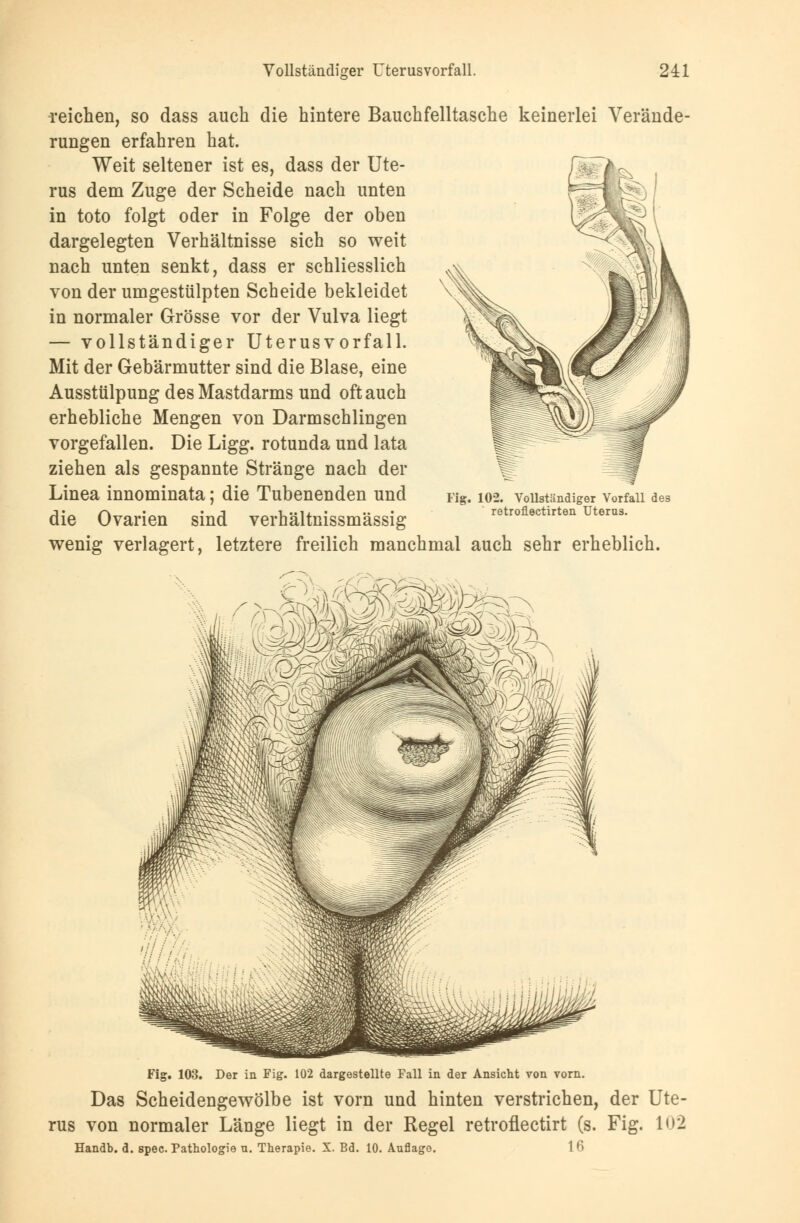 reichen, so dass auch die hintere Bauchfelltasche keinerlei Verände- rungen erfahren hat. Weit seltener ist es, dass der Ute- rus dem Zuge der Scheide nach unten in toto folgt oder in Folge der oben dargelegten Verhältnisse sich so weit nach unten senkt, dass er schliesslich von der umgestülpten Scheide bekleidet in normaler Grösse vor der Vulva liegt — vollständiger Uterusvorfall. Mit der Gebärmutter sind die Blase, eine Ausstülpung des Mastdarms und oft auch erhebliche Mengen von Darmschlingen vorgefallen. Die Ligg. rotunda und lata ziehen als gespannte Stränge nach der Linea innominata; die Tubenenden und die Ovarien sind verhältnissmässig wenig verlagert, letztere freilich manchmal auch sehr erheblich. Fig. 102. Vollständiger Vorfall des retroflectirten Uterus. Fig. 103. Der in Fig. 102 dargestellte Fall in der Ansicht von vorn. Das Scheidengewölbe ist vorn und hinten verstrichen, der Ute- rus von normaler Länge liegt in der Regel retroflectirt (s. Fig. 102 Handb. d. spec. Pathologie u. Therapie. X. Bd. 10. Auflage 16