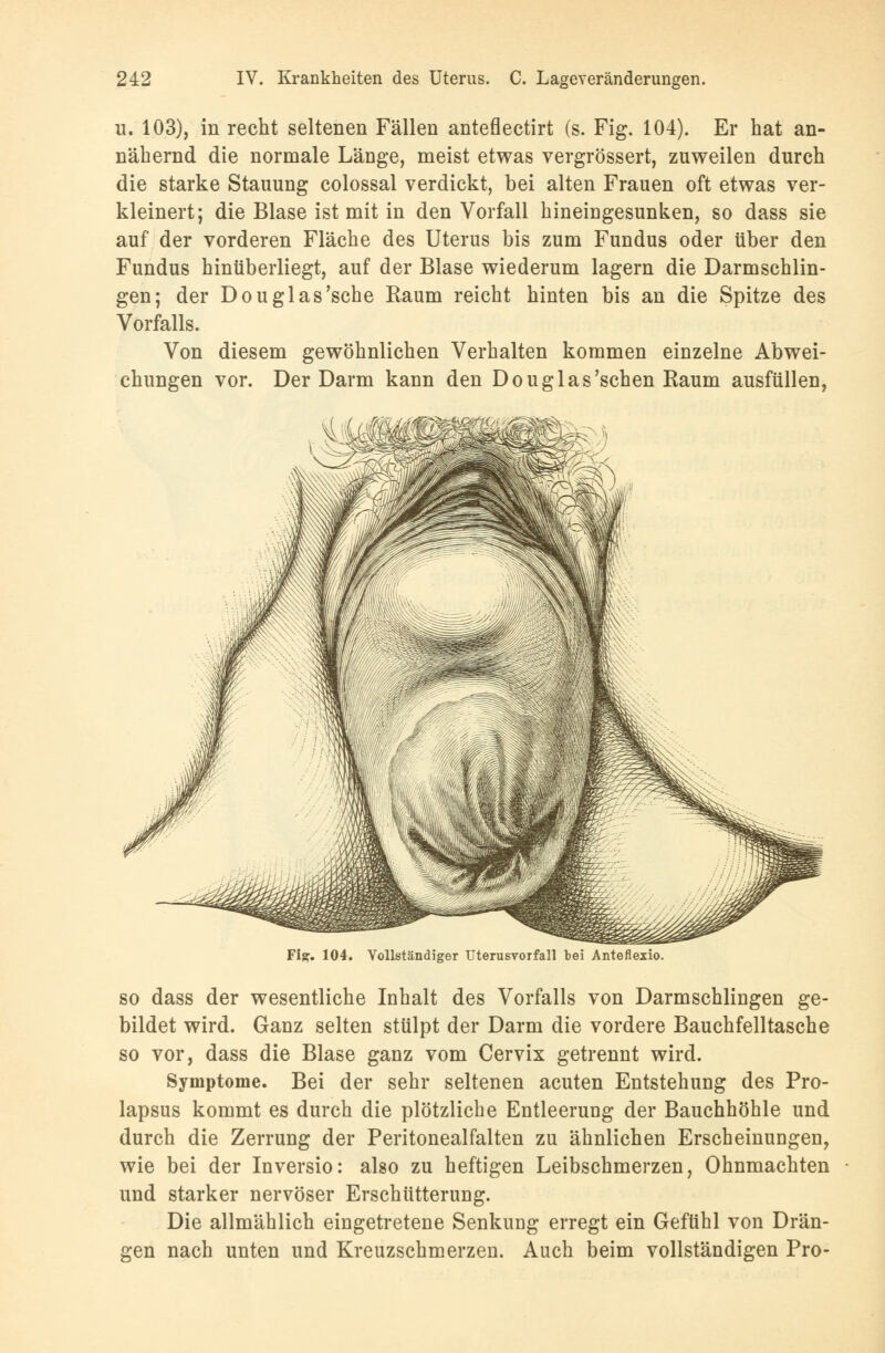 u. 103), in recht seltenen Fällen anteflectirt (s. Fig. 104). Er hat an- nähernd die normale Länge, meist etwas vergrössert, zuweilen durch die starke Stauung colossal verdickt, bei alten Frauen oft etwas ver- kleinert; die Blase ist mit in den Vorfall hineingesunken, so dass sie auf der vorderen Fläche des Uterus bis zum Fundus oder über den Fundus hinüberliegt, auf der Blase wiederum lagern die Darmschlin- gen; der Douglas'sehe Kaum reicht hinten bis an die Spitze des Vorfalls. Von diesem gewöhnlichen Verhalten kommen einzelne Abwei- chungen vor. Der Darm kann den Douglas'schen Raum ausfüllen, Fiff. 104. Vollständiger Uterusvorfall bei Anteflexio. so dass der wesentliche Inhalt des Vorfalls von Darmschlingen ge- bildet wird. Ganz selten stülpt der Darm die vordere Bauchfelltasche so vor, dass die Blase ganz vom Cervix getrennt wird. Symptome. Bei der sehr seltenen acuten Entstehung des Pro- lapsus kommt es durch die plötzliche Entleerung der Bauchhöhle und durch die Zerrung der Peritonealfalten zu ähnlichen Erscheinungen, wie bei der Inversio: also zu heftigen Leibschmerzen, Ohnmächten und starker nervöser Erschütterung. Die allmählich eingetretene Senkung erregt ein Gefühl von Drän- gen nach unten und Kreuzschmerzen. Auch beim vollständigen Pro-