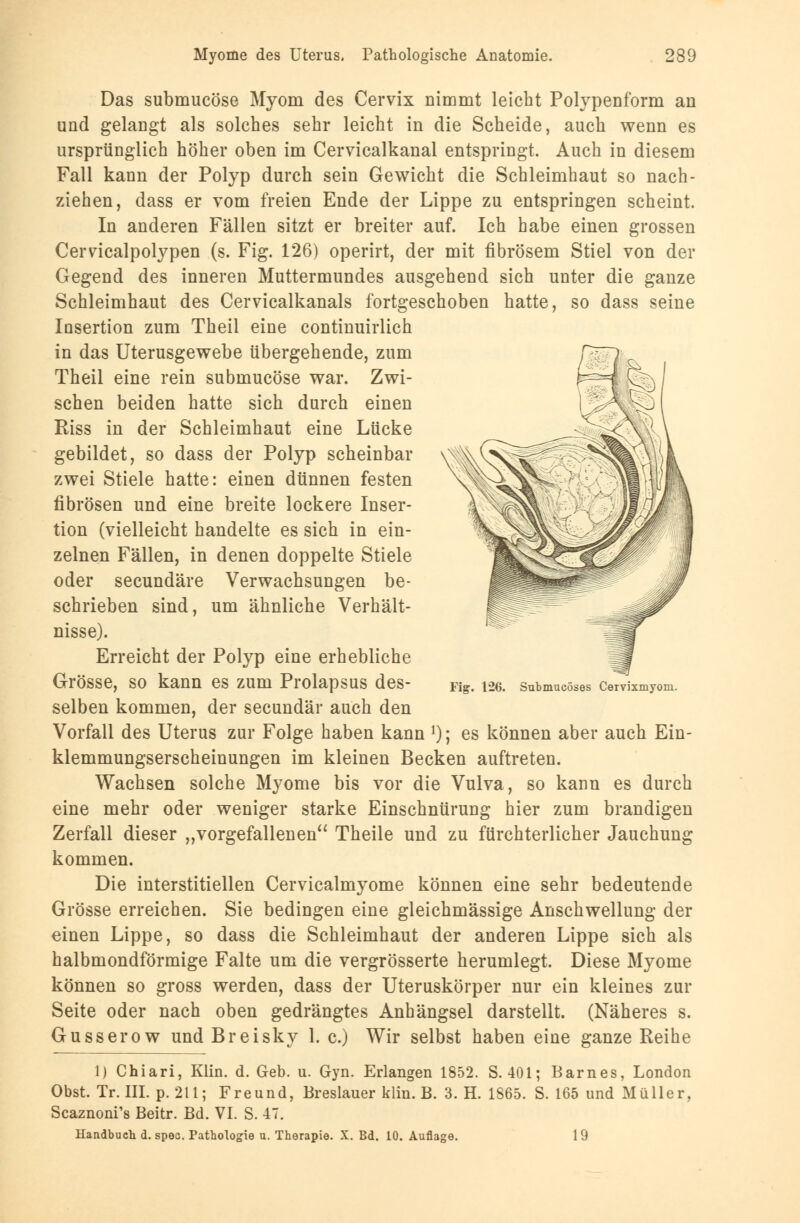 Das submucöse Myom des Cervix nimmt leicht Polypenform an und gelangt als solches sehr leicht in die Scheide, auch wenn es ursprünglich höher oben im Cervicalkanal entspringt. Auch in diesem Fall kann der Polyp durch sein Gewicht die Schleimhaut so nach- ziehen, dass er vom freien Ende der Lippe zu entspringen scheint. In anderen Fällen sitzt er breiter auf. Ich habe einen grossen Cervicalpolypen (s. Fig. 126) operirt, der mit fibrösem Stiel von der Gegend des inneren Muttermundes ausgehend sich unter die ganze Schleimhaut des Cervicalkanals fortgeschoben hatte, so dass seine Insertion zum Theil eine continuirlich in das Uterusgewebe übergehende, zum Theil eine rein submucöse war. Zwi- schen beiden hatte sich durch einen Riss in der Schleimhaut eine Lücke gebildet, so dass der Polyp scheinbar zwei Stiele hatte: einen dünnen festen fibrösen und eine breite lockere Inser- tion (vielleicht handelte es sich in ein- zelnen Fällen, in denen doppelte Stiele oder secundäre Verwachsungen be- schrieben sind, um ähnliche Verhält- nisse). Erreicht der Polyp eine erhebliche Grösse, so kann es zum Prolapsus des- selben kommen, der secundär auch den Vorfall des Uterus zur Folge haben kann *); es können aber auch Ein- klemmungserscheinungen im kleinen Becken auftreten. Wachsen solche Myome bis vor die Vulva, so kann es durch eine mehr oder weniger starke Einschnürung hier zum brandigen Zerfall dieser „vorgefallenen Theile und zu fürchterlicher Jauchung kommen. Die interstitiellen Cervicalmyome können eine sehr bedeutende Grösse erreichen. Sie bedingen eine gleichmässige Anschwellung der einen Lippe, so dass die Schleimhaut der anderen Lippe sich als halbmondförmige Falte um die vergrösserte herumlegt. Diese Myome können so gross werden, dass der Uteruskörper nur ein kleines zur Seite oder nach oben gedrängtes Anhängsel darstellt. (Näheres s. Gusserow und Breisky 1. c.) Wir selbst haben eine ganze Reihe 1) Chiari, Klin. d. Geb. u. Gyn. Erlangen 1852. S. 401; Barnes, London Obst. Tr. III. p. 211; Freund, Breslauer klin. B. 3. H. 1865. S. 165 und Müller, Scaznoni's Beitr. Bd. VI. S. 47. Handbuch d. speo. Pathologie u. Therapie. X. Bd. 10. Auflage. 19 Fig. 126. Submucöses Cervixmyom.