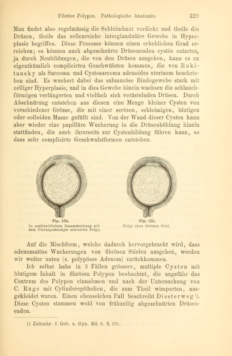 Man findet also regelmässig die Schleimhaut verdickt und theils die Drüsen, theils das zellenreiche interglanduläre Gewebe in Hyper- plasie begriffen. Diese Processe können einen erheblichen Grad er- reichen; es können auch abgeschnürte Drüsenenden cystös entarten, ja durch Neubildungen, die von den Drüsen ausgehen, kann es zu eigenthümlich complicirten Geschwülsten kommen, die von Roki- tansky als Sarcoma und Cystosarcoma adenoides uterinum beschrie- ben sind. Es wuchert dabei das submucöse Bindegewebe stark mit zelliger Hyperplasie, und in dies Gewebe hinein wachsen die schlauch- förmigen verlängerten und vielfach sich verästelnden Drüsen. Durch Abschnürung entstehen aus diesen eine Menge kleiner Cysten von verschiedener Grösse, die mit einer serösen, schleimigen, blutigen oder colloiden Masse gefüllt sind. Von der Wand dieser Cysten kann aber wieder eine papilläre Wucherung in die Drüsenhöhlung hinein stattfinden, die auch ihrerseits zur Cystenbildung führen kann, so dass sehr complicirte Geschwulstformen entstehen. Fi-. 134. Fis;. 135. In continnirlichem Zusammenhang mit Polyp ohne fibrösen Stiel. dem Utemsparenchym stehender Polyp. Auf die Mischform, welche dadurch hervorgebracht wird, dass adenomatöse Wucherungen von fibrösen Stielen ausgehen, werden wir weiter unten (s. polypöses Adenom) zurückkommen. Ich selbst habe in 3 Fällen grössere, multiple Cysten mit blutigem Inhalt in fibrösen Polypen beobachtet, die ungefähr das Centrum des Polypen einnahmen und nach der Untersuchung von C. Rüge mit Cylinderepithelien, die zum Theil wimperten, aus- gekleidet waren. Einen ebensolchen Fall beschreibt Diester weg')• Diese Cysten stammen wohl von frühzeitig abgeschnürten Drüsen- enden. 1) Zeitschr. f. Geb. u. Gyn. Bd. 9. S. 191.