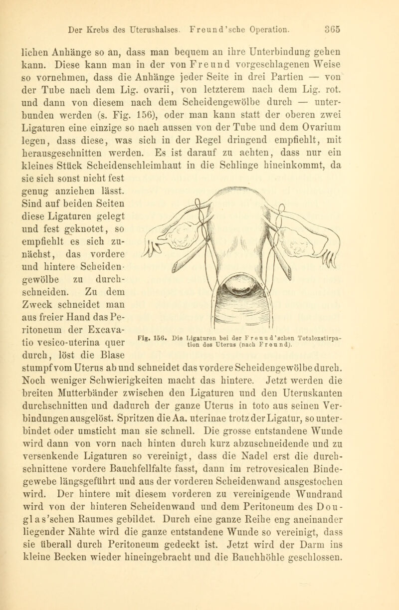 lieben Anhänge so an, dass man bequem an ihre Unterbindung gehen kann. Diese kann man in der von Freund vorgeschlagenen Weise so vornehmen, dass die Anhänge jeder Seite in drei Partien — von der Tube nach dem Lig. ovarii, von letzterem nach dem Lig. rot. und dann von diesem nach dem Scheidengewölbe durch — unter- bunden werden (s. Fig. 156), oder man kann statt der oberen zwei Ligaturen eine einzige so nach aussen von der Tube und dem Ovarium legen, dass diese, was sich in der Regel dringend empfiehlt, mit herausgeschnitten werden. Es ist darauf zu achten, dass nur ein kleines Stück Scheidenschleimhaut in die Schlinge hineinkommt, da sie sich sonst nicht fest genug anziehen lässt. Sind auf beiden Seiten diese Ligaturen gelegt und fest geknotet, so empfiehlt es sich zu- nächst , das vordere und hintere Scheiden- gewölbe zu durch- schneiden. Zu dem Zweck schneidet man aus freier Hand das Pe- ritoneum der Excava- tio vesico-uterina quer durch, löst die Blase stumpf vom Uterus ab und schneidet das vordere Scheidengewölbe durch. Noch weniger Schwierigkeiten macht das hintere. Jetzt werden die breiten Mutterbänder zwischen den Ligaturen und den Uteruskanten durchschnitten und dadurch der ganze Uterus in toto aus seinen Ver- bindungenausgelöst. Spritzen die Aa. uterinae trotz der Ligatur, so unter- bindet oder umsticht man sie schnell. Die grosse entstandene Wunde wird dann von vorn nach hinten durch kurz abzuschneidende und zu versenkende Ligaturen so vereinigt, dass die Nadel erst die durch- schnittene vordere Bauchfellfalte fasst, dann im retrovesicalen Binde- gewebe längsgeführt und aus der vorderen Scheidenwand ausgestochen wird. Der hintere mit diesem vorderen zu vereinigende Wundrand wird von der hinteren Scheidenwand und dem Peritoneum des Dou- glas'schen Raumes gebildet. Durch eine ganze Reihe eng aneinander liegender Nähte wird die ganze entstandene Wunde so vereinigt, dass sie überall durch Peritoneum gedeckt ist. Jetzt wird der Darm ins kleine Becken wieder hineingebracht und die Bauchhöhle geschlossen. Fig. 156. Die Ligaturen bei der F renn d1 sehen Totalexstirpa- tion des Uterus (nach Freund).