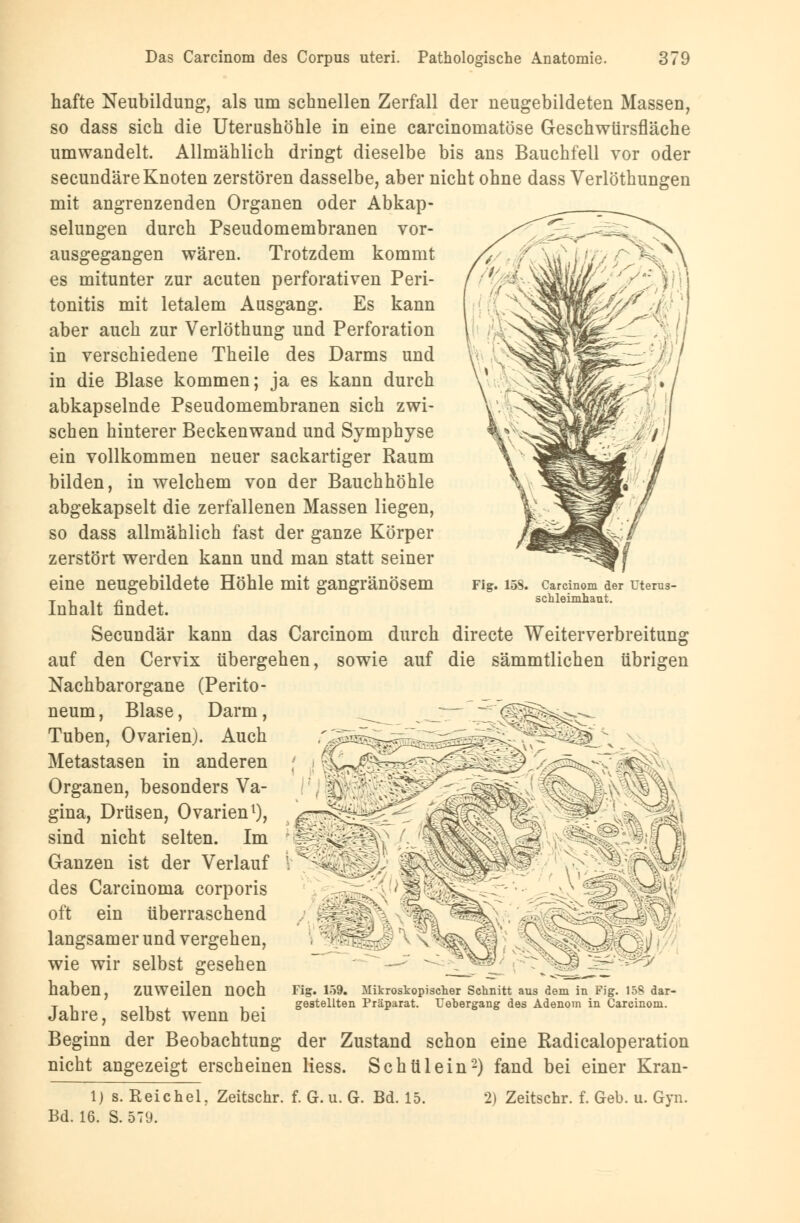 Fig. 158. Carcinom der Uterus- Schleimhaut. hafte Neubildung, als um schnellen Zerfall der neugebildeten Massen, so dass sich die Uterushöhle in eine carcinomatöse Geschwürsfläche umwandelt. Allmählich dringt dieselbe bis ans Bauchfell vor oder secundäre Knoten zerstören dasselbe, aber nicht ohne dass Verlöthungen mit angrenzenden Organen oder Abkap- selungen durch Pseudomembranen vor- ausgegangen wären. Trotzdem kommt es mitunter zur acuten perforativen Peri- tonitis mit letalem Ausgang. Es kann aber auch zur Verlöthung und Perforation in verschiedene Theile des Darms und in die Blase kommen; ja es kann durch abkapselnde Pseudomembranen sich zwi- schen hinterer Beckenwand und Symphyse ein vollkommen neuer sackartiger Raum bilden, in welchem von der Bauchhöhle abgekapselt die zerfallenen Massen liegen, so dass allmählich fast der ganze Körper zerstört werden kann und man statt seiner eine neugebildete Höhle mit gangränösem Inhalt findet. Secundär kann das Carcinom durch directe Weiterverbreitung auf den Cervix übergehen, sowie auf die sämmtlichen übrigen Nachbarorgane (Perito- neum , Blase, Darm, Tuben, Ovarien). Auch Metastasen in anderen Organen, besonders Va- gina, Drüsen, Ovarien1), sind nicht selten. Im Ganzen ist der Verlauf des Carcinoma corporis oft ein überraschend langsamer und vergehen, wie wir selbst gesehen haben, ZUWeilen nOCh Fig. 159. Mikroskopischer Schnitt aus dem in Fig. 158 dar- T , it . t gestellten Präparat. Uehergang des Adenom in Carcinom. Jahre, selbst wenn bei Beginn der Beobachtung der Zustand schon eine Radicaloperation nicht angezeigt erscheinen Hess. Schul ein2) fand bei einer Kran- 1) s. Reichel. Zeitschr. f. G. u. G. Bd. 15. 2) Zeitschr. f. Geb. u. Gyn. Bd. 16. S. 579.