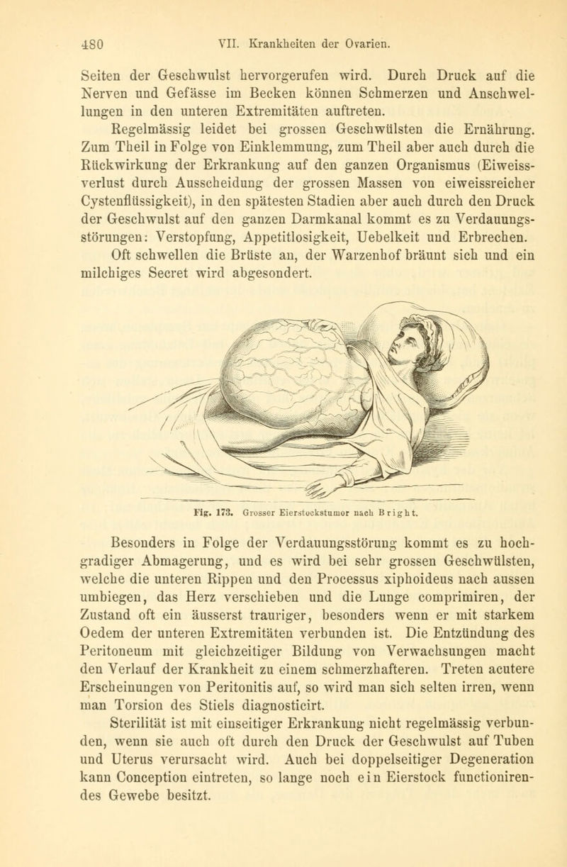 Seiten der Geschwulst hervorgerufen wird. Durch Druck auf die Nerven und Gefässe im Becken können Schmerzen und Anschwel- lungen in den unteren Extremitäten auftreten. Regelmässig leidet bei grossen Geschwülsten die Ernährung. Zum Theil in Folge von Einklemmung, zum Theil aber auch durch die Rückwirkung der Erkrankung auf den ganzen Organismus (Eiweiss- verlust durch Ausscheidung der grossen Massen von eiweissreicher Cystenflüssigkeit), in den spätesten Stadien aber auch durch den Druck der Geschwulst auf den ganzen Darmkanal kommt es zu Verdauungs- störungen: Verstopfung, Appetitlosigkeit, Uebelkeit und Erbrechen. Oft schwellen die Brüste an, der Warzenhof bräunt sich und ein milchiges Secret wird abgesondert. Fig. 173. Grosser Eierstockstumor nach Bright. Besonders in Folge der Verdauungsstörung kommt es zu hoch- gradiger Abmagerung, und es wird bei sehr grossen Geschwülsten, welche die unteren Rippen und den Processus xiphoideus nach aussen umbiegen, das Herz verschieben und die Lunge comprimiren, der Zustand oft ein äusserst trauriger, besonders wenn er mit starkem Oedem der unteren Extremitäten verbunden ist. Die Entzündung des Peritoneum mit gleichzeitiger Bildung von Verwachsungen macht den Verlauf der Krankheit zu einem schmerzhafteren. Treten acutere Erscheinungen von Peritonitis auf, so wird man sich selten irren, wenn man Torsion des Stiels diagnosticirt. Sterilität ist mit einseitiger Erkrankung nicht regelmässig verbun- den, wenn sie auch oft durch den Druck der Geschwulst auf Tuben und Uterus verursacht wird. Auch bei doppelseitiger Degeneration kann Conception eintreten, so lange noch ein Eierstock functioniren- des Gewebe besitzt.