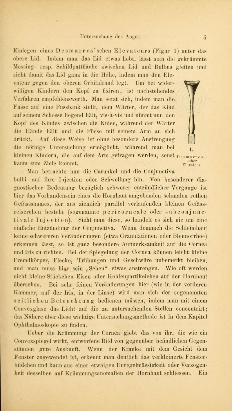 Einlegen eines Desmarr es'schen Elevateurs (Figur 1) unter das obere Lid. [ndem man das Cid etwas liebt, lässt man die gekrümmte Messing- resp. Schildpattfläche zwischen Lid und Bulbus gleiten und zieh! damit das Lid ganz in die Höhe, indem man den Ele- vaieur gegen den oberen Orbitalrand legt. Um bei wider- willigen Kindern den Kopf zu fixiren, ist nachstehendes Verfahren empfehlenswerth. Man setzt sich, indem man die Küsse auf eine Fussbank stellt, dem Wärter, der das Kind auf seinem Schosse liegend hält, vis-ä-vis und nimmt nun deu Kopf des Kindes zwischen die Knice, während der Wärter die Hände hält und die Füsse mit seinem Arm an sich drückt. Auf diese Weise ist ohne besondere Anstrengung die nöthige Untersuchung ermöglicht, während man bei j kleinen Kindern, die auf dem Arm getragen werden, sonst Desmarres- kaum zum Ziele kommt. Eievateur. Man betrachte nun die Carunkel und die Conjunctiva bnlbi auf ihre Injection oder Schwellung hin. Von besonderer dia- gnostischer Bedeutung bezüglich schwerer entzündlicher Vorgänge ist hier das Vorhandensein eines die Hornhaut umgebenden schmalen rothen Gefässsaumes, der aus ziemlich parallel verlaufenden kleinen Gefäss- reiserchen besteht (sogenannte pericorneale oder subconjunc- tivale Injection). Sieht man diese, so handelt es sich nie um eine einfache Entzündung der Conjunctiva. Wenn demnach die Schleimhaut keine schwereren Veränderungen (etwa Granulationen oder Blennorrhoe) erkennen lässt, so ist ganz besondere Aufmerksamkeit auf die Cornea und Iris zu richten. Bei der Spiegelung der Cornea können leicht kleine Fremdkörper, Flecke, Trübungen und Geschwüre unbemerkt bleiben, und man muss hi«i* sein „Sehen etwas anstrengen. Wie oft werden nicht kleine Stückchen Eisen oder Kohlenpartikelchen auf der Hornhaut übersehen. Bei sehr feinen Veränderungen hier (wie in der vorderen Kammer, auf der Iris, in der Linse) wird man sich der sogenannten seitlichen Beleuchtung bedienen müssen, indem man mit einem Convexglase das Licht auf die zu untersuchenden Stellen concentrirt; das Nähere über diese wichtige Untersuchungsmethode ist in dem Kapitel Ophthalmoskopie zu finden. Ueber die Krümmung der Cornea giebt das von ihr, die wie ein Convexspiegel wirkt, entworfene Bild von gegenüber befindlichen Gegen- ständen gute Auskunft. Wenn der Kranke mit dem Gesicht dem Fenster zugewendet ist, erkennt man deutlich das verkleinerte Fenster - bildchcn und kann aus einer etwaigen Unregelmässigkeit oder Verzogen- heit desselben auf Krümmungsanomalien der Hornhaut schliessen. Ein