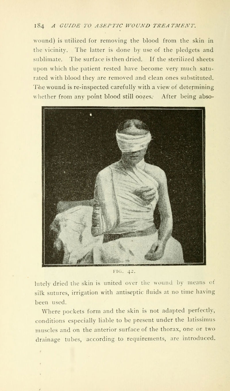 wound) is utilized for removing the blood from the skin in the vicinity. The latter is done by use of the pledgets and sublimate. The surface is then dried. If the sterilized sheets upon which the patient rested have become very much satu- rated with blood they are removed and clean ones substituted. T'he wound is re-inspected carefully with a view of determining wliether from any point blood still oozes.- After being abso- lutely dried the skin is united o\er the wound by means ot silk sutures, irrigation with antiseptic fluids at no time having been used. Where pockets form and the skin is not adapted perfectly, conditions especially liable to be present under the latissimus muscles and on the anterior surface of the thorax, one or two drainage tubes, according to requirements, are introduced.