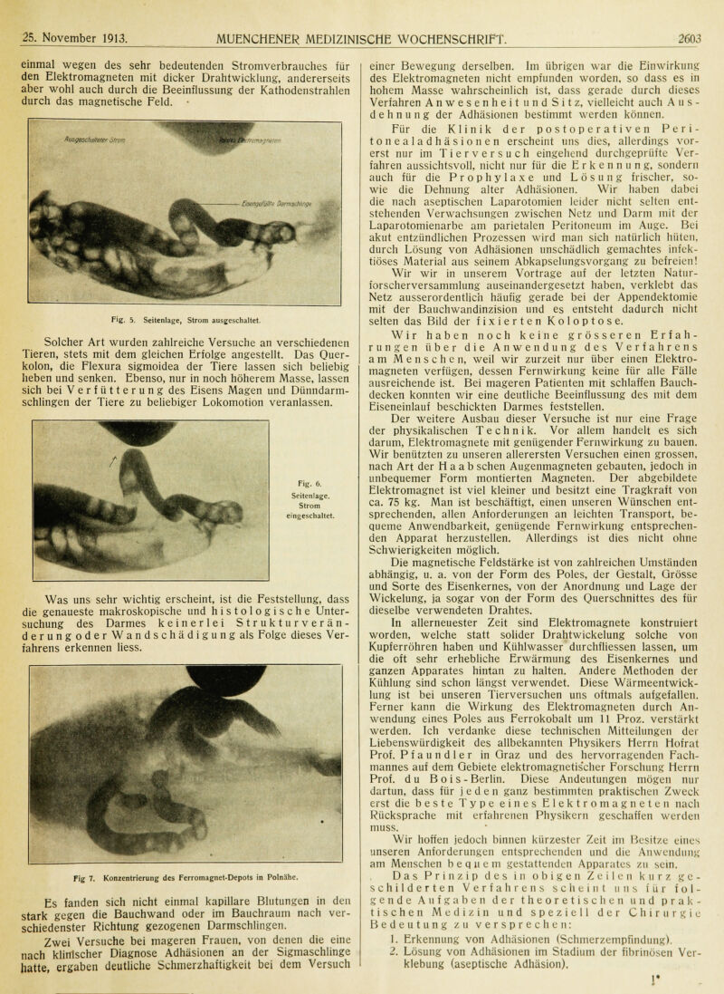 einmal wegen des sehr bedeutenden Stromverbrauches für den Elektromagneten mit dicker Drahtwicklung, andererseits aber wohl auch durch die Beeinflussung der Kathodenstrahlen durch das magnetische Feld. • AusgescM/erer Sirom vmnagneten . l 3örmschlingn ,.^ Fig. 5. Seitenlage, Strom ausgeschaltet. Solcher Art wurden zahlreiche Versuche an verschiedenen Tieren, stets mit dem gleichen Erfolge angestellt. Das Quer- kolon, die Flexura sigmoidea der Tiere lassen sich beliebig lieben und senken. Ebenso, nur in noch höherem Masse, lassen sich bei Verfütterung des Eisens Magen und Dünndarm- schlingen der Tiere zu beliebiger Lokomotion veranlassen. Fig. 6. Seitenlage. Strom eingeschaltet. Was uns sehr wichtig erscheint, ist die Feststellung, dass die genaueste makroskopische und histologische Unter- suchung des Darmes keinerlei Strukturverän- derungoderWandschädigungals Folge dieses Ver- fahrens erkennen liess. Fig 7. Konzentrierung des Ferromagnet-Depots in Polnähe. Es fanden sich nicht einmal kapillare Blutungen in den stark gegen die Bauchwand oder im Bauchraum nach ver- schiedenster Richtung gezogenen Darmschlingen. Zwei Versuche bei mageren Frauen, von denen die eine nach klinischer Diagnose Adhäsionen an der Sigmaschlinge hatte, ergaben deutliche Schmerzhaftigkeit bei dem Versuch einer Bewegung derselben. Im übrigen war die Einwirkung des Elektromagneten nicht empfunden worden, so dass es in hohem Masse wahrscheinlich ist, dass gerade durch dieses Verfahren Anwesenheit undSitz, vielleicht auch Aus- dehnung der Adhäsionen bestimmt werden können. Für die Klinik der postoperativen Peri- tonealadhäsionen erscheint uns dies, allerdings vor- erst nur im Tierversuch eingehend durchgeprüfte Ver- fahren aussichtsvoll, nicht nur für die Erkennung, sondern auch für die Prophylaxe und Lösung frischer, so- wie die Dehnung alter Adhäsionen. Wir haben dabei die nach aseptischen Laparotomien leider nicht selten ent- stehenden Verwachsungen zwischen Netz und Darm mit der Laparotomienarbe am parietalen Peritoneum im Auge. Bei akut entzündlichen Prozessen wird man sich natürlich hüten, durch Lösung von Adhäsionen unschädlich gemachtes infek- tiöses Material aus seinem Abkapselungsvorgang zu befreien! Wir wir in unserem Vortrage auf der letzten Natur- forscherversammlung auseinandergesetzt haben, verklebt das Netz ausserordentlich häufig gerade bei der Appendektomie mit der Bauchwandinzision und es entsteht dadurch nicht selten das Bild der fixierten Koloptose. Wir haben noch keine grösseren Erfah- rungen über die Anwendung des Verfahrens am Menschen, weil wir zurzeit nur über einen Elektro- magneten verfügen, dessen Fernwirkung keine für alle Fälle ausreichende ist. Bei mageren Patienten mit schlaffen Bauch- decken konnten wir eine deutliche Beeinflussung des mit dem Eiseneinlauf beschickten Darmes feststellen. Der weitere Ausbau dieser Versuche ist nur eine Frage der physikalischen Technik. Vor allem handelt es sich darum, Elektromagnete mit genügender Fernwirkung zu bauen. Wir benützten zu unseren allerersten Versuchen einen grossen, nach Art der Haab sehen Augenmagneten gebauten, jedoch in unbequemer Form montierten Magneten. Der abgebildete Elektromagnet ist viel kleiner und besitzt eine Tragkraft von ca. 75 kg. Man ist beschäftigt, einen unseren Wünschen ent- sprechenden, allen Anforderungen an leichten Transport, be- queme Anwendbarkeit, genügende Fernwirkung entsprechen- den Apparat herzustellen. Allerdings ist dies nicht ohne Schwierigkeiten möglich. Die magnetische Feldstärke ist von zahlreichen Umständen abhängig, u. a. von der Form des Poles, der Gestalt, Grösse und Sorte des Eisenkernes, von der Anordnung und Lage der Wickelung, ja sogar von der Form des Querschnittes des für dieselbe verwendeten Drahtes. In allerneuester Zeit sind Elektromagnete konstruiert worden, welche statt solider Drahtwickelung solche von Kupferröhren haben und Kühlwasser durchfliessen lassen, um die oft sehr erhebliche Erwärmung des Eisenkernes und ganzen Apparates hintan zu halten. Andere Methoden der Kühlung sind schon längst verwendet. Diese Wärmeentwick- lung ist bei unseren Tierversuchen uns oftmals aufgefallen. Ferner kann die Wirkung des Elektromagneten durch An- wendung eines Poles aus Ferrokobalt um 11 Proz. verstärkt werden. Ich verdanke diese technischen Mitteilungen der Liebenswürdigkeit des allbekannten Physikers Herrn Hofrat Prof. Pfaundler in Graz und des hervorragenden Fach- mannes auf dem Gebiete elektromagnetischer Forschung Herrn Prof. du B o i s - Berlin. Diese Andeutungen mögen nur dartun, dass für jeden ganz bestimmten praktischen Zweck erst die beste Type eines Elektromagneten nach Rücksprache mit erfahrenen Physikern geschaffen werden muss. Wir hoffen jedoch binnen kürzester Zeit im Besitze eines unseren Anforderungen entsprechenden und die Anwendung am Menschen bequem gestattenden Apparates zu sein. Das Prinzip des in obigen Zeilen kurz ge- schilderten Verfahrens scheint uns für fol- gende Aufgaben der theoretischen und prak- tischen Medizin und speziell der Chirurgie Bedeutung zu versprechen: 1. Erkennung von Adhäsionen (Schmerzempfindung). 2. Lösung von Adhäsionen im Stadium der fibrinösen Ver- klebung (aseptische Adhäsion). r