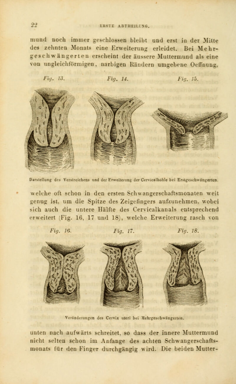 Diiuid noch immer geschlossen bleibt und erst in der Mitte des zehnten Monats eine Erweiterung erleidet. Bei Mehr- - b - erteil erscheint der äußere Muttermund als eine von ungleichförmigen, narbigen Rändern umgebene Oeffnung. Fig. 14. -' Darstellung des Verstreichens und der Erweiterung der Cerviealhöble bei Erstgeschwängerten. welche oft schon in den ersten Schwangerschaftsmonaten weit genug ist. um die Spitze des Zeigefingers aufzunehmen, wobei sich auch die untere Hälfte des Cervicalkanals entsprechend erweitert Fi*. 16, IT und 18 . welche Erweiterung rasch von Fig. 16. Fig. 17. Fia. 18. Veränderungen des Cervix uteri bei Mehriresibwänfferten unten nach aufwärts schreitet, so dass der innere Muttermund nicht selten schon im Anfange des achten Schwangerschafts- monats für den Finger durchgängig wird. Die beiden Mutter-