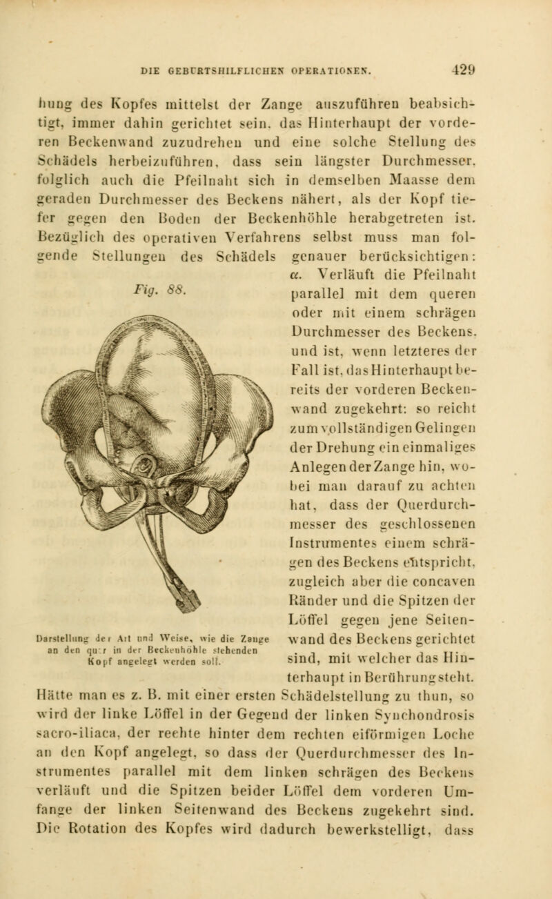 hang des Kopfes mittelst der Zange auszuführen beabsich- tigt, immer dahin gerichtet sein. das Hinterhaupt der vorde- ren Beckenwand zuzudrehen und eine solche Stellung des SchSdels herbeizuführen, dass sein längster Durchmesser. folglich auch die Pfeilnaht sich in demselben Maasse dem geraden Durchmesser des Beckens nähert, als der Kopf tie- fer gegen den Boden der Beckenhöhle herabgetreten ist. Bezüglich des operativen Verfahrens selbst muss man fol- gende Stellungen des Schädels genauer berücksichtigen: a. Verläuft die Pfeilnaht parallel mit dem queren oder mit einem schrägen Durchmesser des Beckens, und ist, wenn letzteres der Fall ist. das Hinterhaupt be- reits der vorderen Becken- wand zugekehrt: so reicht zum vollständigen Gelingen der Drehung ein einmaliges Anlegender Zange hin, wo- bei man darauf zu achten hat, dass der Querdurch- messer des geschlossenen Instrumentes einem schrä- gen des Beckens entspricht, zugleich aber die coneaven Ränder und die Spitzen der Löffel gegen jene Seilen- wand des Beckens gerichtet sind, mit welcher das Hin- terhaupt in Bertihrungsteht Hätte man es z. B. mit einer ersten Schädelstellung zu tlmn. bo wird der linke Löffel in der Gegend der linken Bynchondrosis sacro-iliaca, der rechte hinter dem rechten eiförmigen Loche an den Kopf angelegt, so das> der Querdurchmesser des In- strumentes parallel mit dem linken schrägen des Beckens verläuft und die Spitzen beider Löffel dem vorderen L'm- faage der linken Seitenwand des Beckens zugekehrt sind. Die Rotation des Kopfes wird dadurch bewerkstelligt, dass Darstellung ie i Ait un.l Weise, wie die Zaiitre an den qur in der Beckeiihohle stehenden Ko|f angelegt werden soll.