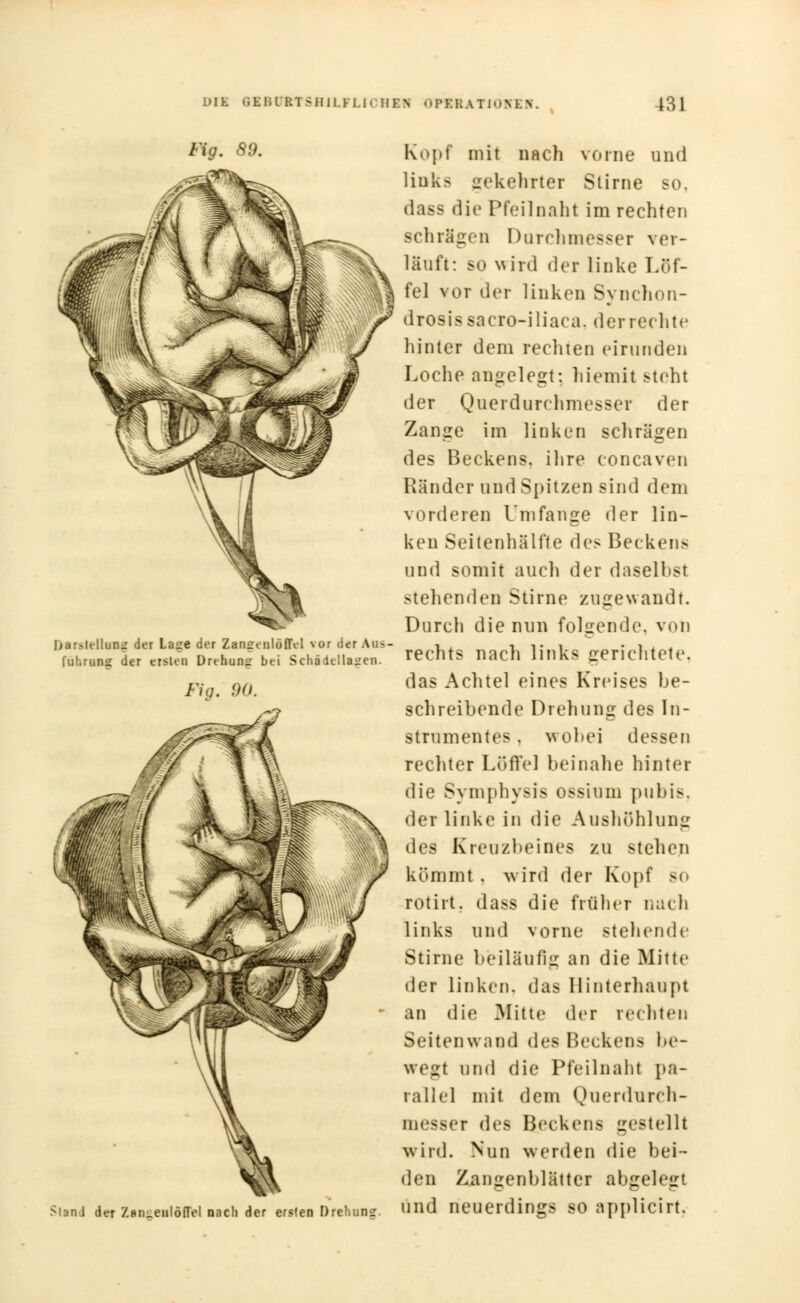 Fig. SO. Darstellung der Lage der Zangenlöffel vor der Aus fuhrung der ersten Drehung bei Schädellagen. Fig. 90. Stand der Zan^enlöffel nach der ersten Drehung Kopf mit nach vorne und links gekehrter Stime so. dass die Pfeilnaht im rechten schlagen Durchmesser ver- läuft: so wird der linke Löf- fel vor der linken 8) nchon- drosissacro-iliaca. der rechte hinter dem rechten eirunden Loche angelegt: hiemit steht der Querdurchmesser der Zange im linken schrägen des Beckens, ihre coneaven Ränder und Spitzen sind dem vorderen Umfange der lin- ken Seitenhälfte des Beckens und somit auch der daselhst stehenden Stirne zugewandt. Durch die nun folgende, von rechts nach links gerichtete. das Achtel eines Kreises be- schreibende Drehung des In- strumentes , wobei dessen rechter Löffel beinahe hinter die Symphysis ossium pubis, der linkt4 in die Aushöhlung • les Kreuzbeines zu stehen kömmt . wird der Kopf bo rotirt. dass die früher nach links und vorne stehende Stirne beiläufig an die Mitte der linken, das Hinterhaupt an die Mitte der rechten Seitenwand des Beckens be- wegt und die Pfeilnaht pa- rallel mit dem Queidurch- messer des Beckens gestellt wird. Nun werden die bei- den Zangenblättcr abgelegt und neuerdings so applicirt.