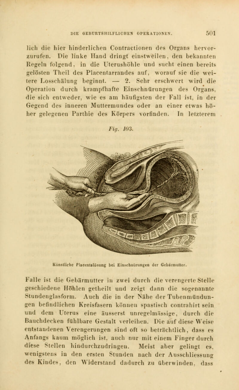 lieh die liier hinderlichen Contractionen dos Organs hervor- zurufen. Die linke Hand dringt einstweilen, den bekannten Regeln folgend, in die l'terusliühle und sucht einen bereits gelösten Theil des Plaeentarrandes auf, worauf sie die wei- tere Losschälung beginnt. — 2. Sehr erschwert wird die Operation durch krampfhafte Einschnürungen (\c< Organs, die sich entweder, wie es am häufigsten der Fall ist, in der Gegend des inneren Mutlermundes oder an einer etwas hö- her gelegenen Parthie des Körpers vorfinden. In letzterem Fig. KU. Künstliche Placentalösung bei Einschnürungen der Gebärmutter. Falle i>t die Ciebärmutter in zwei durch die verengerte Stelle geschiedene Höhlen getheilt und zeigl dann die sogenannte Stundenglasform. Auch die in der Nähe der Tubenmündun- gen befindlichen Kreisfasern können Bpastisch contrahirf sein und dem Uterus eine äusserst an regelmässige, durch die Bauchdecken fühlbare Gestalt verleihen. Die auf diese Weise entstandenen Verengerungen sind oft so beträchtlich, dass es Anfangs kaum möglich ist, auch nur mit einem Finger durch diese Stellen hilldurchzudringen. Meist aber gelingt es. wenigstens in den ersten Stunden nach der Ausschliessung des Kindes, den Widerstand dadurch zu überwinden, dass
