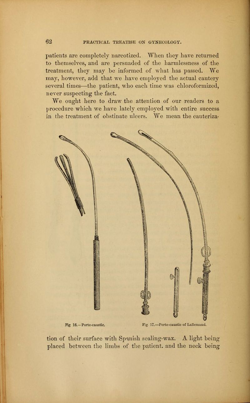 patients are completely narcotized. When they have returned to themselves, and are persuaded of the harmlessness of the treatment, they may be informed of what has passed. We may, however, add that we have employed the actual cautery several times—the patient, who each time was chloroformized, never suspecting the fact. We ought here to draw the attention of our readers to a procedure which we have lately employed with entire success in the treatment of obstinate ulcers. We mean the cauteriza- Pig 16.—Porte-caustic. Fig. 17.—Porte-caustic of Lallemand. tion of their surface with Spanish sealing-wax. A light being placed between the limbs of the patient, and the neck being