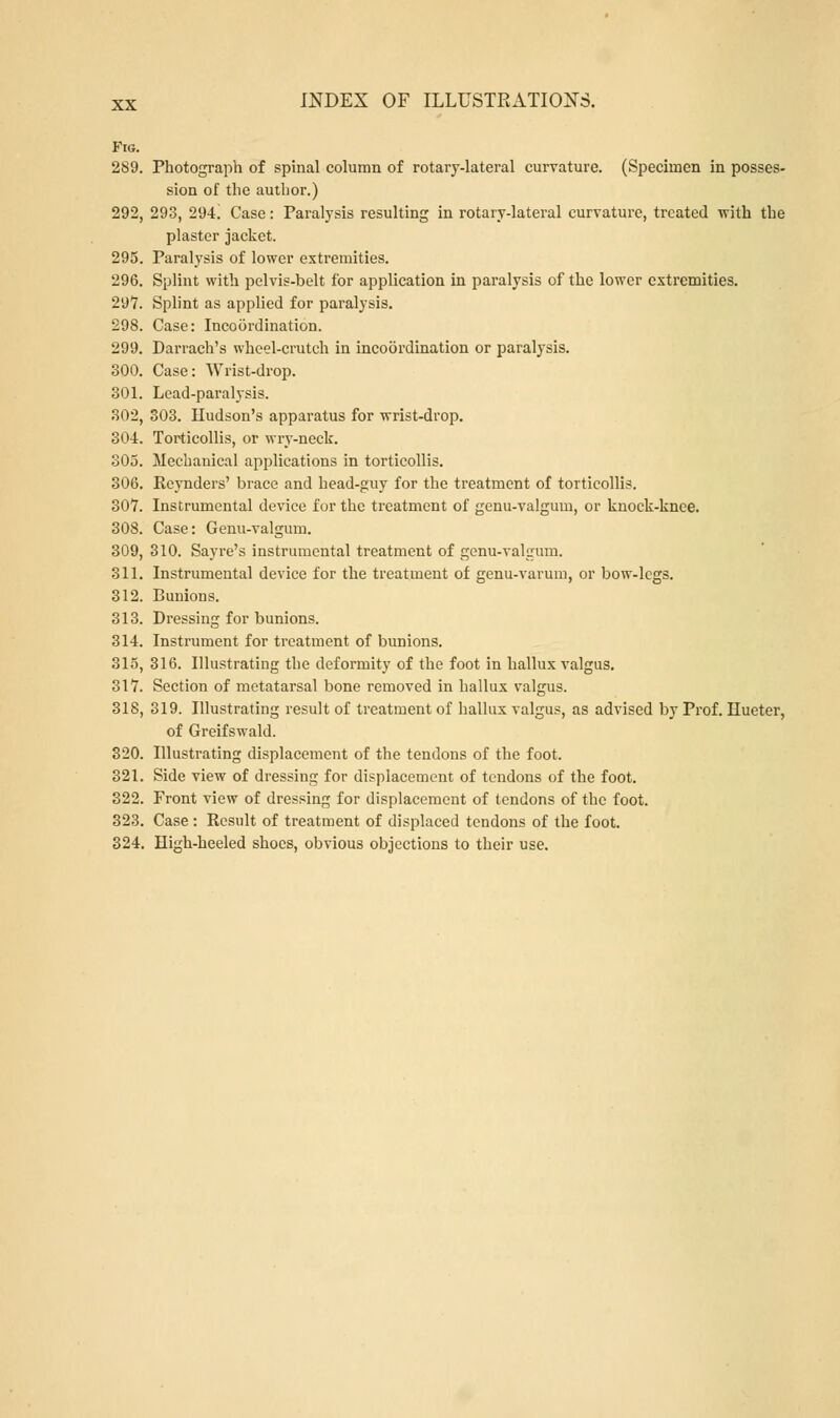 Ftg. 289. Photograph of spinal column of rotary-lateral curvature. (Specimen in posses- sion of the author.) 292, 293, 294! Case: Paralysis resulting in rotary-lateral curvature, treated with the plaster jacket. 295. Paralysis of lower extremities. 296. Splint with pelvis-belt for application in paralysis of the lower extremities. 297. Splint as applied for paralysis. 298. Case: Incoordination. 299. Darrach's wheel-crutch in incoordination or paralysis. 300. Case: Wrist-drop. 301. Lead-paralysis. 302. 303. Hudson's apparatus for wrist-drop. 304. Torticollis, or wry-neck. 305. Mechanical applications in torticollis. 306. Ecynders' brace and head-guy for the treatment of torticollis. 307. Instrumental device for the treatment of genu-valgum, or knock-knee. 308. Case: Genu-valgum. 309. 310. Sayre's instrumental treatment of genu-valgum. 311. Instrumental device for the treatment of genu-varum, or bow-legs. 312. Bunions. 313. Dressing for bunions. 314. Instrument for treatment of bunions. 315. 316. Illustrating the deformity of the foot in hallux valgus. 317. Section of metatarsal bone removed in hallux valgus. 318, 319. Illustrating result of treatment of hallux valgus, as advised by Prof. Hueter, of Greifswald. 320. Illustrating displacement of the tendons of the foot. 321. Side view of dressing for displacement of tendons of the foot. 322. Front view of dressing for displacement of tendons of the foot. 323. Case : Result of treatment of displaced tendons of the foot. 324. High-heeled shoes, obvious objections to their use.