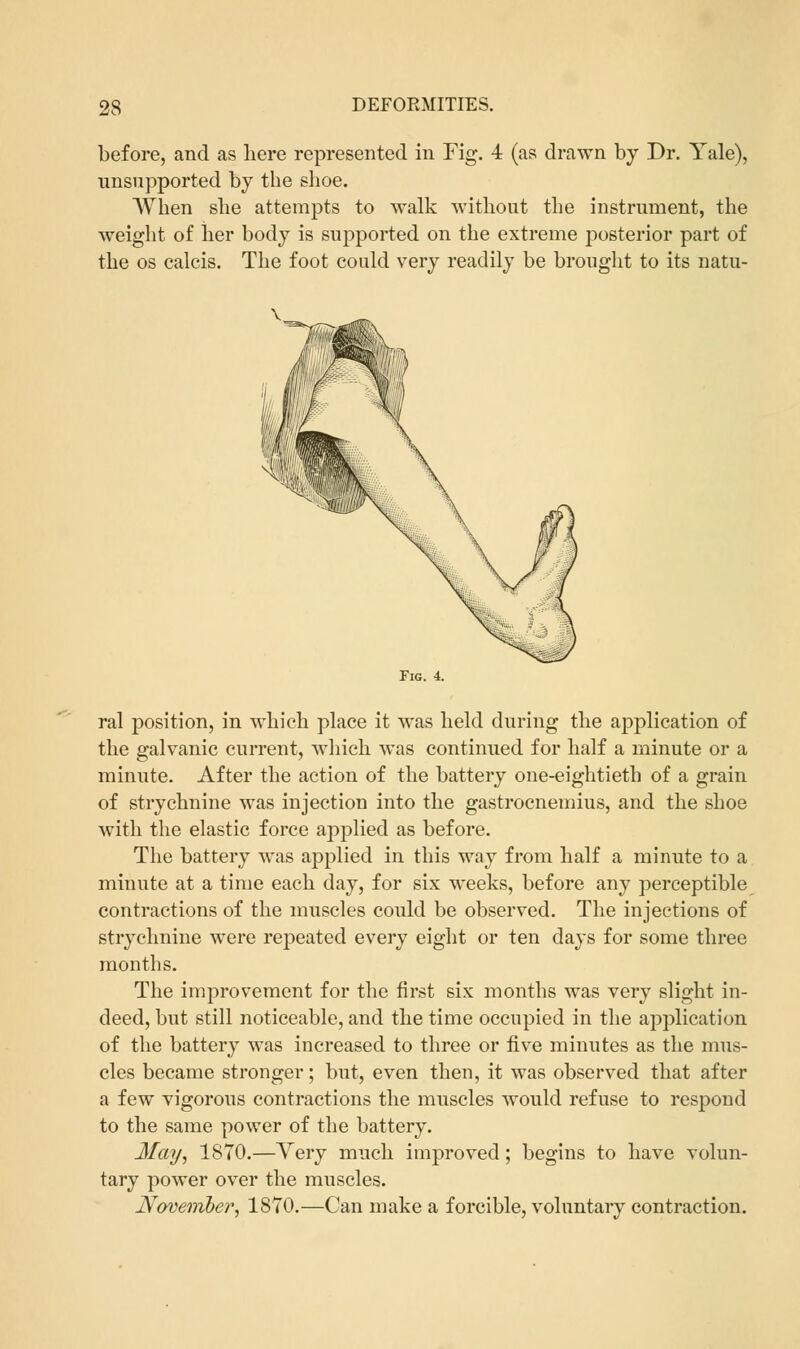 before, and as here represented in Fig. 4 (as drawn by Dr. Yale), unsupported by the shoe. When she attempts to walk without the instrument, the weight of her body is supported on the extreme posterior part of the os calcis. The foot could very readily be brought to its natu- Fig. 4. ral position, in which place it was held during the application of the galvanic current, which was continued for half a minute or a minute. After the action of the battery one-eightieth of a grain of strychnine was injection into the gastrocnemius, and the shoe with the elastic force applied as before. The battery was applied in this way from half a minute to a minute at a time each day, for six weeks, before any perceptible contractions of the muscles could be observed. The injections of strychnine were repeated every eight or ten days for some three months. The improvement for the first six months was very slight in- deed, but still noticeable, and the time occupied in the application of the battery was increased to three or five minutes as the mus- cles became stronger; but, even then, it was observed that after a few vigorous contractions the muscles would refuse to respond to the same power of the battery. May, 1870.—Yery much improved; begins to have volun- tary power over the muscles. November, 1870.—Can make a forcible, voluntary contraction.