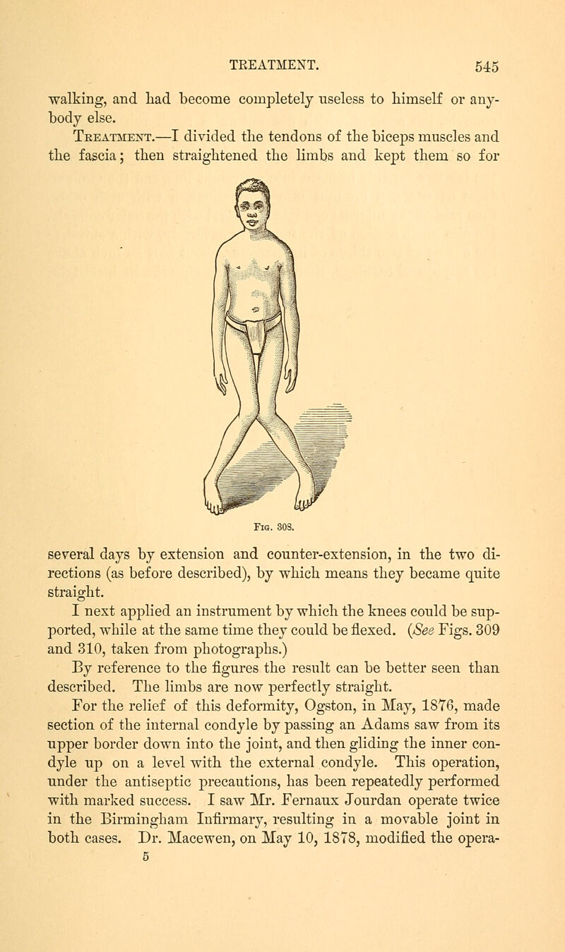 walking, and had become completely useless to himself or any- body else. Treatment.—I divided the tendons of the biceps muscles and the fascia; then straightened the limbs and kept them so for Fig. 308. several days by extension and counter-extension, in the two di- rections (as before described), by which means they became quite straight. I next applied an instrument by which the knees could be sup- ported, while at the same time they could be flexed. {See Figs. 309 and 310, taken from photographs.) By reference to the figures the result can be better seen than described. The limbs are now perfectly straight. For the relief of this deformity, Ogston, in May, 1876, made section of the internal condyle by passing an Adams saw from its upper border down into the joint, and then gliding the inner con- dyle up on a level with the external condyle. This operation, under the antiseptic precautions, has been repeatedly performed with marked success. I saw Mr. Fernaux Jourdan operate twice in the Birmingham Infirmary, resulting in a movable joint in both cases. Dr. Macewen, on May 10, 1878, modified the opera- 5