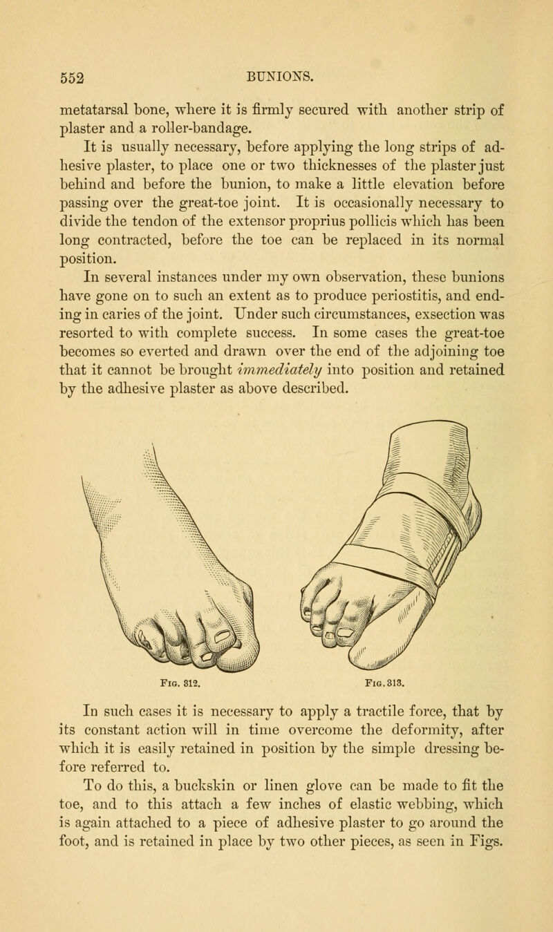 metatarsal bone, where it is firmly secured with another strip of plaster and a roller-bandage. It is usually necessary, before applying the long strips of ad- hesive plaster, to place one or two thicknesses of the plaster just behind and before the bunion, to make a little elevation before passing over the great-toe joint. It is occasionally necessary to divide the tendon of the extensor proprius pollicis which has been long contracted, before the toe can be replaced in its normal position. In several instances under my own observation, these bunions have gone on to such an extent as to produce periostitis, and end- ing in caries of the joint. Under such circumstances, exsection was resorted to with complete success. In some cases the great-toe becomes so everted and drawn over the end of the adjoining toe that it cannot be brought immediately into position and retained by the adhesive plaster as above described. Fig. 812. Fig. 313. In such cases it is necessary to apply a tractile force, that by its constant action will in time overcome the deformity, after which it is easily retained in position by the simple dressing be- fore referred to. To do this, a buckskin or linen glove can be made to fit the toe, and to this attach a few inches of elastic webbing, which is again attached to a piece of adhesive plaster to go around the foot, and is retained in place by two other pieces, as seen in Figs.