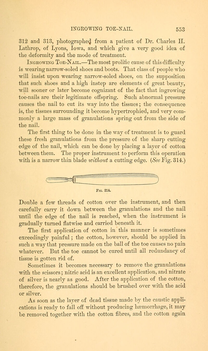 312 and 313, photographed from a patient of Dr. Charles H. Lathrop, of Lyons, Iowa, and which give a very good idea of the deformity and the mode of treatment. Ingrowing Toe-Nail.—The most prolific cause of this difficulty is wearing narrow-soled shoes and boots. That class of people who will insist upon wearing narrow-soled shoes, on the supposition that such shoes and a high instep are elements of great beauty, will sooner or later become cognizant of the fact that ingrowing toe-nails are their legitimate offspring. Such abnormal pressure causes the nail to cut its way into the tissues; the consequence is, the tissues surrounding it become hypertrophied, and very com- monly a large mass of granulations spring out from the side of the nail. The first thing to be done in the way of treatment is to guard these fresh granulations from the pressure of the sharp cutting edge of the nail, which can be done by placing a layer of cotton between them. The proper instrument to perform this operation with is a narrow thin blade without a cutting edge. {See Fig. 314.) Fig. 314. Double a few threads of cotton over the instrument, and then carefully carry it down between the granulations and the nail until the edge of the nail is reached, when the instrument is gradually turned flatwise and carried beneath it. The first application of cotton in this manner is sometimes exceedingly painful; the cotton, however, should be applied in such a way that pressure made on the ball of the toe causes no pain whatever. But the toe cannot be cured until all redundancy of tissue is gotten rid of. Sometimes it becomes necessary to remove the granulations with the scissors; nitric acid is an excellent application, and nitrate of silver is nearly as good. After the application of the cotton, therefore, the granulations should be brushed over with the acid or silver. As soon as the layer of dead tissue made by the caustic appli- cations is ready to fall off without producing haemorrhage, it may be removed together with the cotton fibres, and the cotton again
