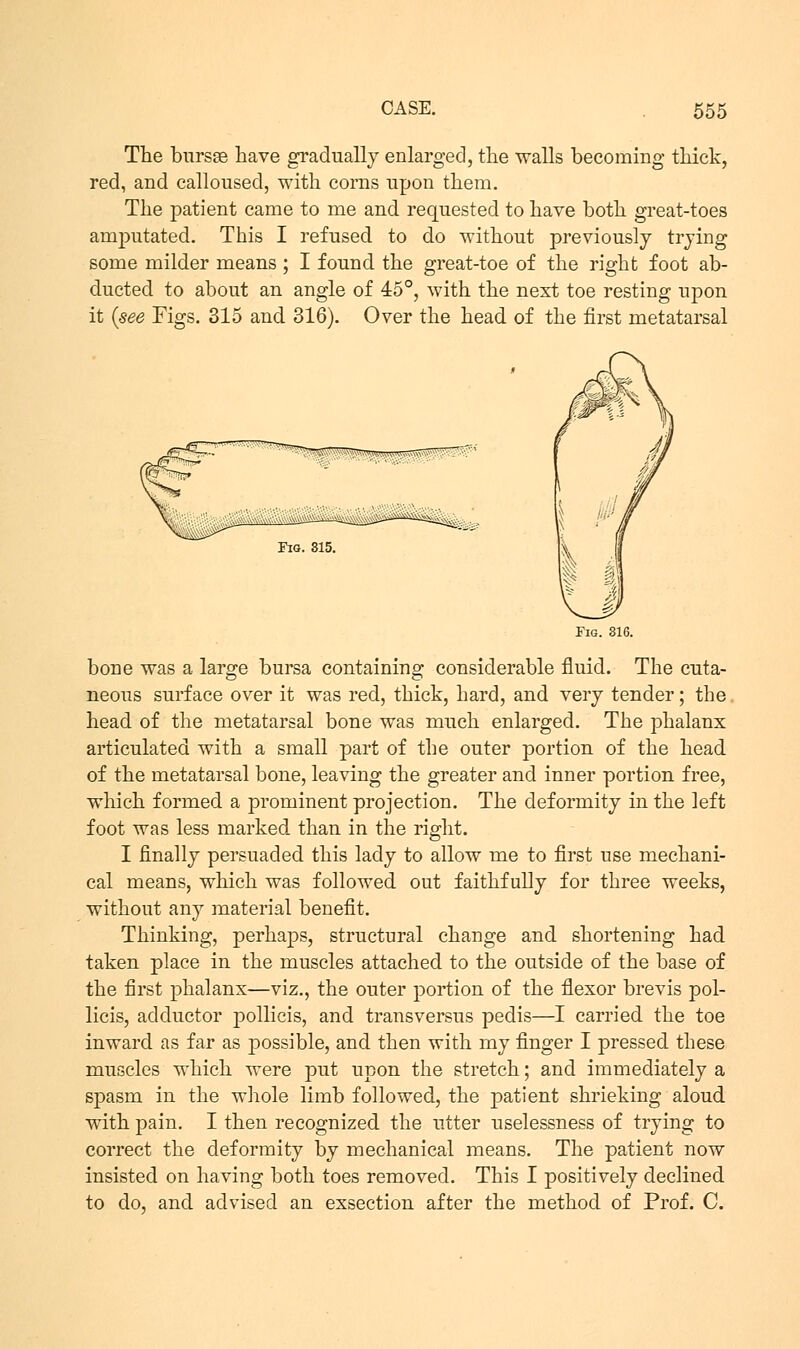 The bursse have gradually enlarged, the walls becoming thick, red, and calloused, with corns upon them. The patient came to me and requested to have both great-toes amputated. This I refused to do without previously trying some milder means; I found the great-toe of the right foot ab- ducted to about an angle of 45°, with the next toe resting upon it {see Figs. 315 and 316). Over the head of the first metatarsal Fig. 315. Fig. 316. bone was a large bursa containing considerable fluid. The cuta- neous surface over it was red, thick, hard, and very tender; the head of the metatarsal bone was much enlarged. The phalanx articulated with a small part of the outer portion of the head of the metatarsal bone, leaving the greater and inner portion free, which formed a prominent projection. The deformity in the left foot was less marked than in the right. I finally persuaded this lady to allow me to first use mechani- cal means, which was followed out faithfully for three weeks, without any material benefit. Thinking, perhaps, structural change and shortening had taken place in the muscles attached to the outside of the base of the first phalanx—viz., the outer portion of the flexor brevis pol- licis, adductor pollicis, and transversus pedis—I carried the toe inward as far as possible, and then with my finger I pressed these muscles which were put upon the stretch; and immediately a spasm in the whole limb followed, the patient shrieking aloud with pain. I then recognized the utter uselessness of trying to correct the deformity by mechanical means. The patient now insisted on having both toes removed. This I positively declined to do, and advised an exsection after the method of Prof. C.