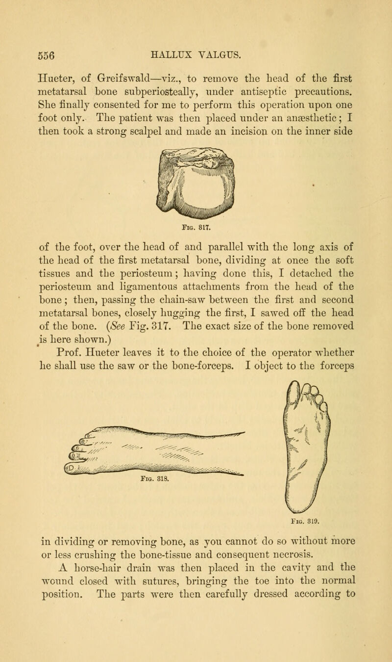 Hueter, of Greifswald—viz., to remove the head of the first metatarsal bone subperiosteal])', under antiseptic precautions. She finally consented for me to perform this operation upon one foot only. The patient was then placed under an anaesthetic; I then took a strong scalpel and made an incision on the inner side Fig. 817. of the foot, over the head of and parallel with the long axis of the head of the first metatarsal bone, dividing at once the soft tissues and the periosteum; having done this, I detached the periosteum and ligamentous attachments from the head of the bone; then, passing the chain-saw between the first and second metatarsal bones, closely hugging the first, I sawed off the head of the bone. {See Fig. 317. The exact size of the bone removed ^is here shown.) Prof. Hueter leaves it to the choice of the operator whether he shall use the saw or the bone-forceps. I object to the forceps Fig. 310. in dividing or removing bone, as you cannot do so without more or less crushing the bone-tissue and consequent necrosis. A horse-hair drain was then placed in the cavity and the wound closed with sutures, bringing the toe into the normal position. The parts were then carefully dressed according to