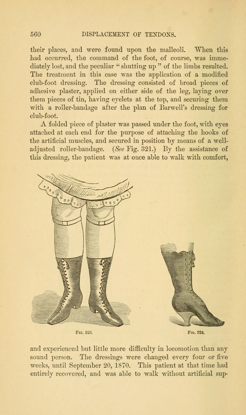 their places, and were found upon the malleoli. When this had occurred, the command of the foot, of course, was imme- diately lost, and the peculiar shutting up of the limbs resulted. The treatment in this case was the application of a modified club-foot dressing. The dressing consisted of broad pieces of adhesive plaster, applied on either side of the leg, laying over them pieces of tin, having eyelets at the top, and securing them with a roller-bandage after the plan of Barwell's dressing for club-foot. A folded piece of plaster was passed under the foot, with eyes attached at each end for the purpose of attaching the hooks of the artificial muscles, and secured in position by means of a well- adjusted roller-bandage. (See Fig. 321.) By the assistance of this dressing, the patient was at once able to walk with comfort, Fig. 323. Fig. 324. and experienced but little more difficulty in locomotion than any sound person. The dressings were changed every four or five weeks, until September 20, 1870. This patient at that time had entirely recovered, and was able to walk without artificial sup-