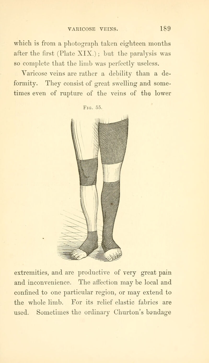 which is from a photograph taken eighteen months after the first (Plate XIX.); but the paralysis was so complete that the limb was perfectly useless. Varicose veins are rather a debility than a de- formity. They consist of great swelling and some- times even of rupture of the veins of the lower Fig. 55. extremities, and are productive of very great pain and inconvenience. The affection may be local and confined to one particular region, or may extend to the whole limb. For its relief elastic fabrics are used. Sometimes the ordinary Churton's bandage