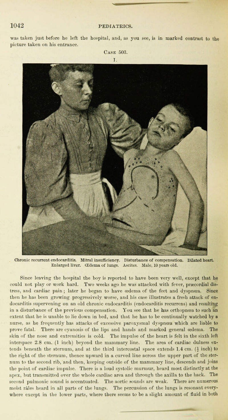 was taken just before he left the hospital, and, as you see, is in marked contrast to the picture taken on his entrance. Case 503. T. Chronic recurrent endocarditis. Mitral insufficiency. Disturbance of compensation. Enlarged liver. (Edema of lungs. Ascites. Male, 10 years old. Dilated heart. Since leaving the hospital the boy is reported to have been very well, except that he could not play or work hard. Two weeks ago he was attacked with fever, precordial dis- tress, and cardiac pain; later he began to have oedema of the feet and dyspnoea. Since then he has been growing progressively worse, and his case illustrates a fresh attack of en- docarditis supervening on an old chronic endocarditis (endocarditis recurrens) and resulling in a disturbance of the previous compensation. You see that he has orthopnoea to such an extent that he is unable to lie down in bed, and that he has to be continually watched by a nurse, as he frequently has attacks of excessive paroxysmal dyspnoea which are liable to prove fatal. There are cyanosis of the lips and hands and marked general cedema. The skin of the nose and extremities is cold. The impulse of the heart is felt in the sixth left interspace 2.8 cm. (1 inch) beyond the mammary line. The area of cardiac dulness ex- tends beneath the sternum, and at the third intercostal space extends 1.4 cm. (I inch) to the right of the sternum, thence upward in a curved line across the upper part of the ster- num to the second rih, and then, keeping outside of the mammary line, descends and joins the point of cardiac impulse. There is a loud systolic murmur, heard most distinctly at the apex, but transmitted over the whole cardiac area and through the axilla to the back. The second pulmonic sound is accentuated. The aortic sounds are weak. There are numerous moist rales heard in all parts of the lungs. The percussion of the lungs is resonant every- where except in the lower parts, where there seems to he a slight amount of fluid in both