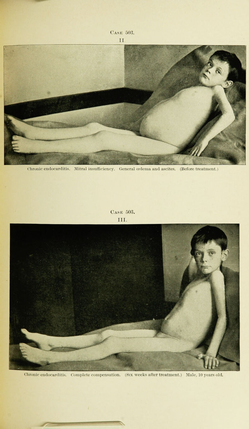 I limine endocarditis. Mitral insufficiency. General oedema and ascites. (Before treatment.)