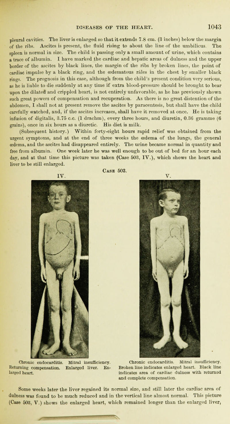 pleural cavities. The liver is enlarged so that it extends 7.8 cm. (3 inches) below the margin of the ribs. Ascites is present, the fluid rising to about the line of the umbilicus. The spleen is normal in size. The child is passing only a small amount of urine, which contains a trace of albumin. I have marked the cardiac and hepatic areas of dulness and the upper border of the ascites by black lines, the margin of the ribs by broken lines, the point of cardiac impulse by a black ring, and the cedematous rales in the chest by smaller black rings. The prognosis in this case, although from the child's present condition very serious, as he is liable to die suddenly at any time if extra blood-pressure should be brought to bear upon the dilated and crippled heart, is not entirely unfavorable, as he has previously shown such great powers of compensation and recuperation. As there is no great distention of the abdomen, I shall not at present remove the ascites by paracentesis, but shall have the child carefully watched, and, if the ascites increases, shall have it removed at once. He is taking infusion of digitalis, 3.75 c.c. (1 drachm), every three hours, and diuretin, 0.36 gramme (6 grains), once in six hours as a diuretic. His diet is milk. (Subsequent history.) Within forty-eight hours rapid relief was obtained from the urgent symptoms, and at the end of three weeks the oedema of the lungs, the general cedema, and the ascites had disappeared entirely. The urine became normal in quantity and free from albumin. One week later he was well enough to be out of bed for an hour each day, and at that time this picture was taken (Case 503, IV.), which shows the heart and liver to be still enlarged. Case 503. IV. V. Chronic endocarditis. Mitral insufficiency. Returning compensation. Enlarged liver. En- larged heart. Chronic endocarditis. Mitral insufficiency. Broken line indicates enlarged heart. Black line indicates area of cardiac dulness with retumad and complete compensation. Some weeks later the liver regained its normal size, and still later the cardiac area of dulness was found to be much reduced and in the vertical line almost normal. This picture (Case 503, V.) shows the enlarged heart, which remained longer than the enlarged liver.