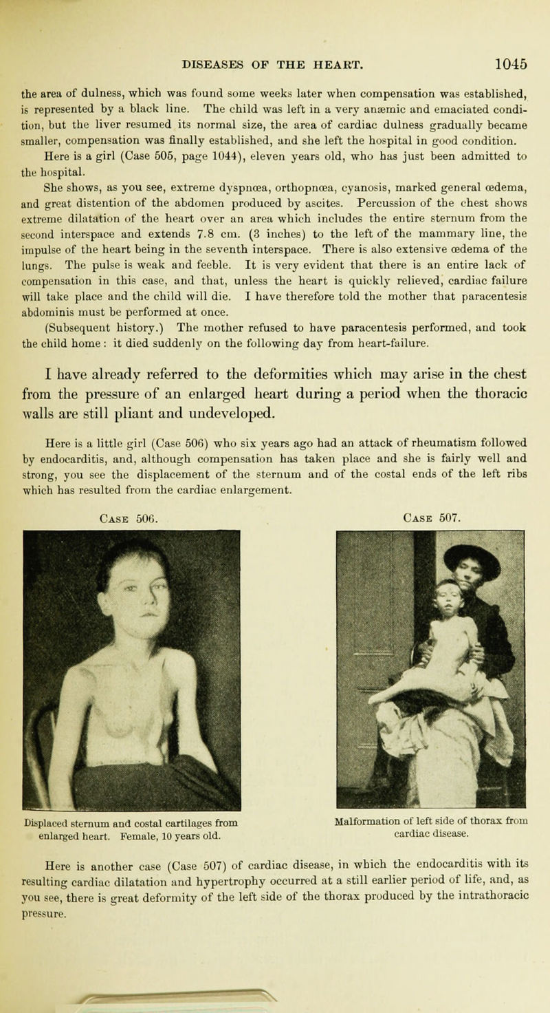 the area of dulness, which was found some weeks later when compensation was established, is represented by a black line. The child was left in a very ansemic and emaciated condi- tion, but the liver resumed its normal size, the area of cardiac dulness gradually became smaller, compensation was finally established, and she left the hospital in good condition. Here is a girl (Case 505, page 1044), eleven years old, who has just been admitted to the hospital. She shows, as you see, extreme dyspnoea, orthopncea, cyanosis, marked general oedema, and great distention of the abdomen produced by ascites. Percussion of the chest shows extreme dilatation of the heart over an area which includes the entire sternum from the second interspace and extends 7.8 cm. (3 inches) to the left of the mammary line, the impulse of the heart being in the seventh interspace. There is also extensive oedema of the lungs. The pulse is weak and feeble. It is very evident that there is an entire lack of compensation in this case, and that, unless the heart is quickly relieved, cardiac failure will take place and the child will die. I have therefore told the mother that paracentesis abdominis must be performed at once. (Subsequent history.) The mother refused to have paracentesis performed, and took the child home: it died suddenly on the following day from heart-failure. I have already referred to the deformities which may arise in the chest from the pressure of an enlarged heart during a period when the thoracic walls are still pliant and undeveloped. Here is a little girl (Case 506) who six years ago had an attack of rheumatism followed by endocarditis, and, although compensation has taken place and she is fairly well and strong, you see the displacement of the sternum and of the costal ends of the left ribs which has resulted from the cardiac enlargement. Case 506. Case 507. Displaced sternum and costal cartilages from enlarged heart. Female, 10 years old. Malformation of left side of thorax from cardiac disease. Here is another case (Case 507) of cardiac disease, in which the endocarditis with its resulting cardiac dilatation and hypertrophy occurred at a still earlier period of life, and, as you see, there is great deformity of the left side of the thorax produced by the intrathoracic pressure.