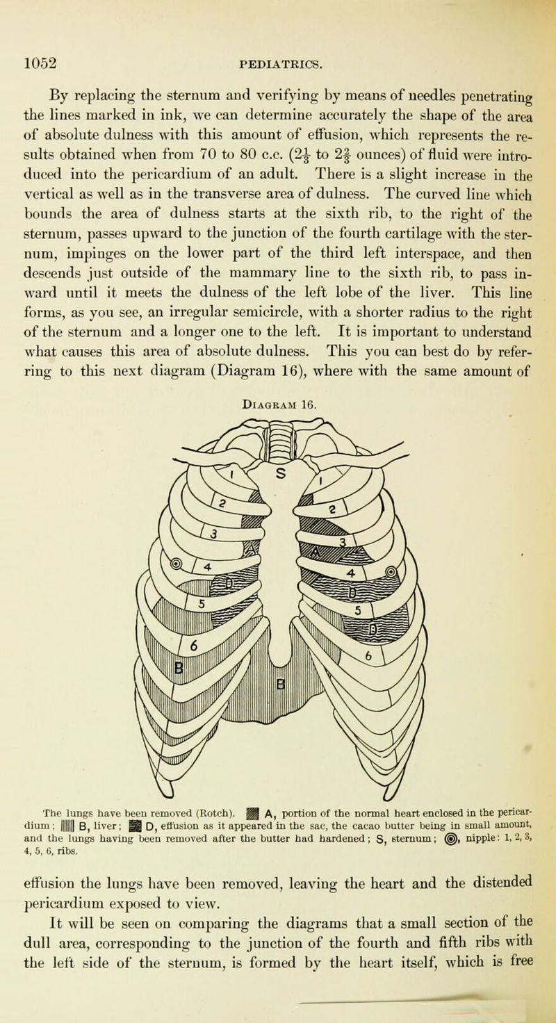 By replacing the sternum and verifying by means of needles penetrating the lines marked in ink, we can determine accurately the shape of the area of absolute dulness with this amount of effusion, which represents the re- sults obtained when from 70 to 80 c.c. (2^ to 2J ounces) of fluid were intro- duced into the pericardium of an adult. There is a slight increase in the vertical as well as in the transverse area of dulness. The curved line which bounds the area of dulness starts at the sixth rib, to the right of the sternum, passes upward to the junction of the fourth cartilage with the ster- num, impinges on the lower part of the third left interspace, and then descends just outside of the mammary line to the sixth rib, to pass in- ward until it meets the dulness of the left lobe of the liver. This line forms, as you see, an irregular semicircle, with a shorter radius to the right of the sternum and a longer one to the left. It is important to understand what causes this area of absolute dulness. This you can best do by refer- ring to this next diagram (Diagram 16), where with the same amount of Diagram 16. The lungs have been removed (Rotch). ||J A, portion of the normal heart enclosed in the pericar- dium ; llll B, liver; §§ D effusion as it appeared in the sac, the cacao butter being in small amount, and the lungs having been removed after the butter had hardened; S, sternum; @), nipple; 1,2,3, 4, 5, 6, ribs. effusion the lungs have been removed, leaving the heart and the distended pericardium exposed to view. It will be seen on comparing the diagrams that a small section of the dull area, corresponding to the junction of the fourth and fifth ribs with the left side of the sternum, is formed by the heart itself, which is free