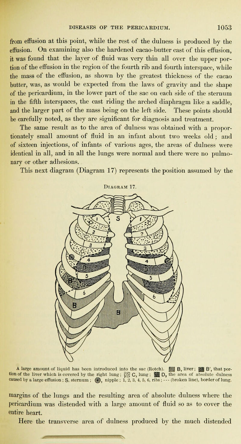 from effusion at this point, while the rest of the dulness is produced by the effusion. On examining also the hardened cacao-butter cast of this eifusion, it was found that the layer of fluid was very thin all over the upper por- tion of the effusion in the region of the fourth rib and fourth interspace, while the mass of the eifusion, as shown by the greatest thickness of the cacao butter, was, as would be expected from the laws of gravity and the shape of the pericardium, in the lower part of the sac on each side of the sternum in the fifth interspaces, the cast riding the arched diaphragm like a saddle, and the larger part of the mass being on the left side. These points should be carefully noted, as they are significant for diagnosis and treatment. The same result as to the area of dulness was obtained with a propor- tionately small amount of fluid in an infant about two weeks old ; and of sixteen injections, of infants of various ages, the areas of dulness were identical in all, and in all the lungs were normal and there were no pulmo- nary or other adhesions. This next diagram (Diagram 17) represents the position assumed by the Diagram 17. A large amount of liquid has been introduced into the sac (Rotch). ||||| B, liver; jjj]} B', that por- tion of the liver which is covered by the right lung ; jSj c, lung ; i| D, the area of absolute dulness caused by a large effusion ; S. sternum ; (U, nipple ; 1, 2, 3, 4, 5, 6, ribs; - - - (broken line), border of lung. margins of the lungs and the resulting area of absolute dulness where the pericardium was distended with a large amount of fluid so as to cover the entire heart. Here the transverse area of dulness produced by the much distended N