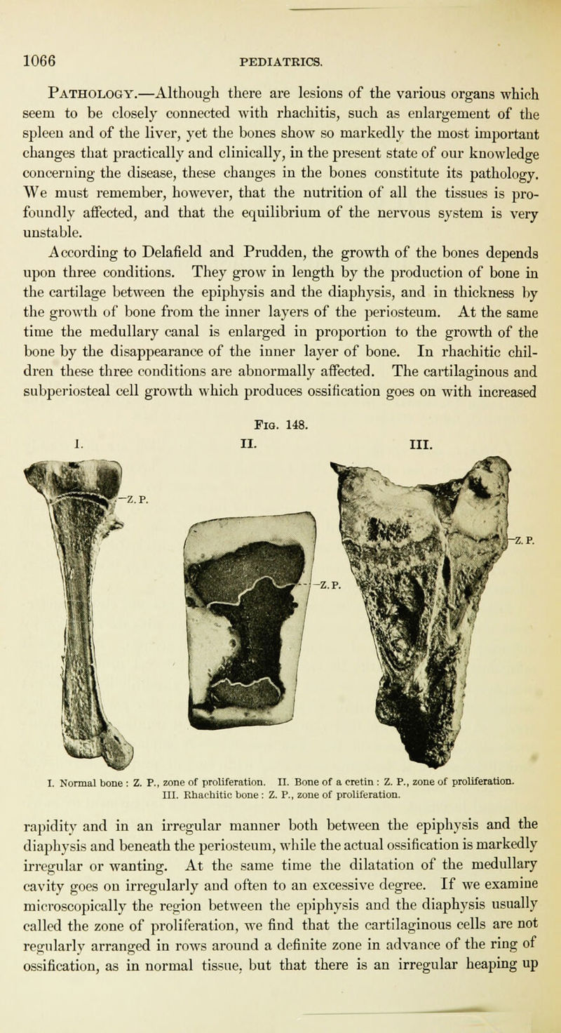 Pathology.—Although there are lesious of the various organs which seem to be closely connected with rhachitis, such as enlargement of the spleen and of the liver, yet the bones show so markedly the most important changes that practically and clinically, in the present state of our knowledge concerning the disease, these changes in the bones constitute its pathology. We must remember, however, that the nutrition of all the tissues is pro- foundly affected, and that the equilibrium of the nervous system is very unstable. According to Delafield and Prudden, the growth of the bones depends upon three conditions. They grow in length by the production of bone in the cartilage between the epiphysis and the diaphysis, and in thickness by the growth of bone from the inner layers of the periosteum. At the same time the medullary canal is enlarged in proportion to the growth of the bone by the disappearance of the inner layer of bone. In rhachitic chil- dren these three conditions are abnormally affected. The cartilaginous and subperiosteal cell growth which produces ossification goes on with increased Fiq. 148. —z.p. z.p. I. Normal bone : Z. P., zone of proliferation. II. Bone of a cretin: Z. P., zone of proliferation. III. Rhachitic bone : Z. P., zone of proliferation. rapidity and in an irregular manner both between the epiphysis and the diaphysis and beneath the periosteum, while the actual ossification is markedly irregular or wanting. At the same time the dilatation of the medullary cavity goes on irregularly and often to an excessive degree. If we examine microscopically the region between the epiphysis and the diaphysis usually called the zone of proliferation, we find that the cartilaginous cells are not regularly arranged in rows around a definite zone in advance of the ring of ossification, as in normal tissue, but that there is an irregular heaping up