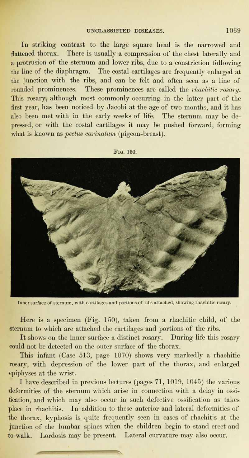 In striking contrast to the large square head is the narrowed and flattened thorax. There is usually a compression of the chest laterally and a protrusion of the sternum and lower ribs, due to a constriction following the line of the diaphragm. The costal cartilages are frequently enlarged at the junction with the ribs, and can be felt and often seen as a line of rounded prominences. These prominences are called the rhachitic rosary. This rosary, although most commonly occurring in the latter part of the first year, has been noticed by Jacobi at the age of two months, and it has also been met with in the early weeks of life. The sternum may be de- pressed, or with the costal cartilages it may be pushed forward, forming what is known as pectus carinatum (pigeon-breast). Fig. 150. Inner surface of sternum, with cartilages and portions of ribs attached, showing rhachitic rosary. Here is a specimen (Fig. 150), taken from a rhachitic child, of the sternum to which are attached the cartilages and portions of the ribs. It shows on the inner surface a distinct rosary. During life this rosary could not be detected on the outer surface of the thorax. This infant (Case 513, page 1070) shows very markedly a rhachitic rosary, with depression of the lower part of the thorax, and enlarged epiphyses at the wrist. I have described in previous lectures (pages 71, 1019, 1045) the various deformities of the sternum which arise in connection with a delay in ossi- fication, and which may also occur in such defective ossification as takes place in rhachitis. In addition to these anterior and lateral deformities of the thorax, kyphosis is quite frequently seen in cases of rhachitis at the junction of the lumbar spines when the children begin to stand erect and to walk. Lordosis may be present. Lateral curvature may also occur.