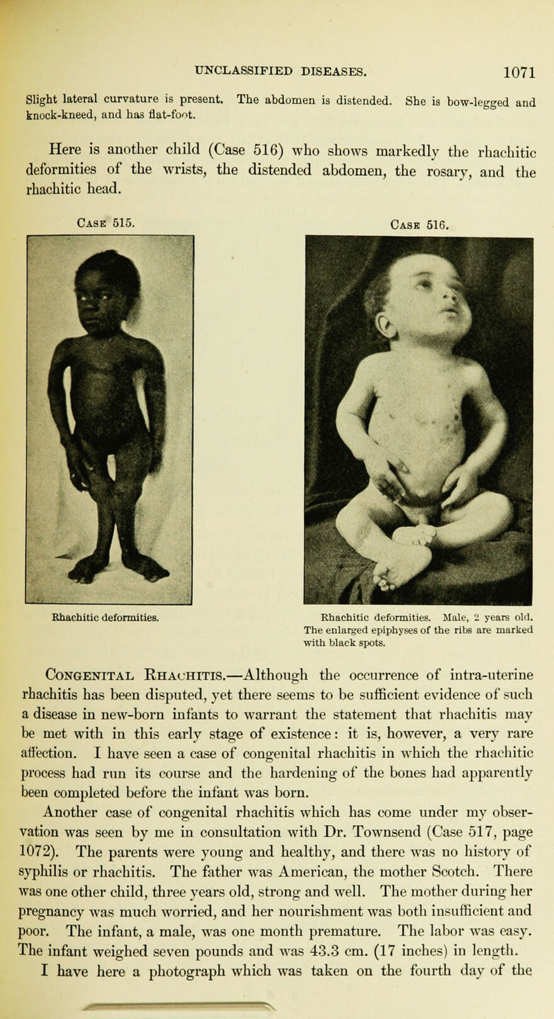 Slight lateral curvature is present. The abdomen is distended. She is bow-legged and knock-kneed, and has flat-foot. Here is another child (Case 516) who shows markedly the rhaehitic deformities of the wrists, the distended abdomen, the rosary, and the rhaehitic head. Case 515. Cask 516. Rhaehitic deformities. Rhaehitic deformities. Male, 2 years old. The enlarged epiphyses of the ribs are marked with black spots. Congenital Rhachitis.—Although the occurrence of intra-uterine rhachitis has been disputed, yet there seems to be sufficient evidence of such a disease in new-born infants to warrant the statement that rhachitis may be met with in this early stage of existence: it is, however, a very rare affection. I have seen a case of congenital rhachitis in which the rhaehitic process had run its course and the hardening of the bones had apparently been completed before the infant was born. Another case of congenital rhachitis which has come under my obser- vation was seen by me in consultation with Dr. Townsend (Case 517, page 1072). The parents were young and healthy, and there was no history of syphilis or rhachitis. The father was American, the mother Scotch. There was one other child, three years old, strong and well. The mother during her pregnancy was much worried, and her nourishment was both insufficient and poor. The infant, a male, was one month premature. The labor was easy. The infant weighed seven pounds and was 43.3 cm. (17 inches) in length. I have here a photograph which was taken on the fourth day of the