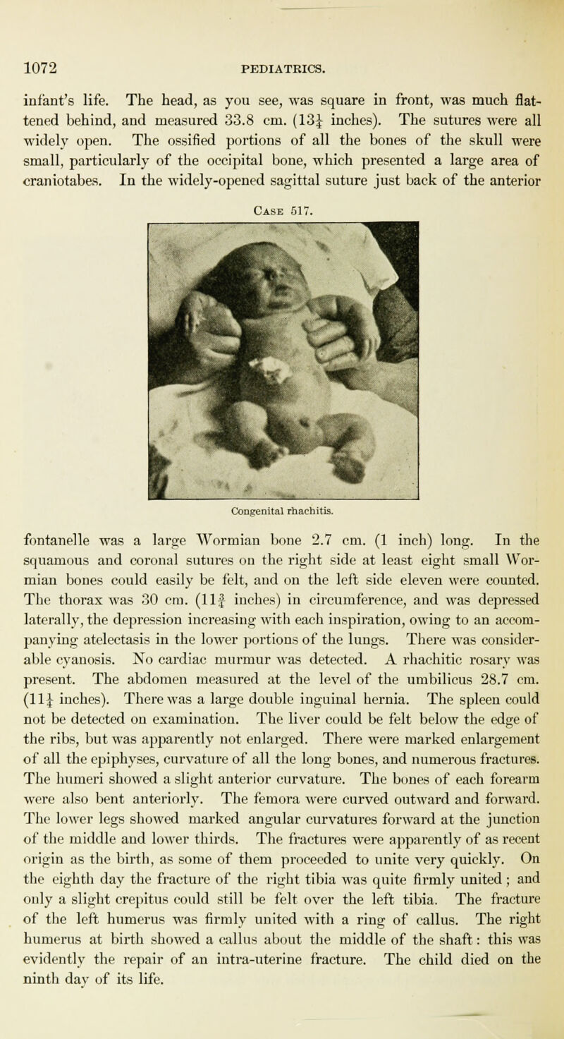 infant's life. The head, as you see, was square in front, was much flat- tened behind, and measured 33.8 cm. (13J inches). The sutures were all widely open. The ossified portions of all the bones of the skull were small, particularly of the occipital bone, which presented a large area of craniotabes. In the widely-opened sagittal suture just back of the anterior Case 517. Congenital rhachitis. fontanelle was a large Wormian bone 2.7 cm. (1 inch) long. In the squamous and coronal sutures on the right side at least eight small Wor- mian bones could easily be felt, and on the left side eleven were counted. The thorax was 30 cm. (11J inches) in circumference, and was depressed laterally, the depression increasing with each inspiration, owing to an accom- panying atelectasis in the lower portions of the lungs. There was consider- able cyanosis. No cardiac murmur was detected. A rhachitic rosary was present. The abdomen measured at the level of the umbilicus 28.7 cm. (11J inches). There was a large double inguinal hernia. The spleen could not be detected on examination. The liver could be felt below the edge of the ribs, but was apparently not enlarged. There were marked enlargement of all the epiphyses, curvature of all the long bones, and numerous fractures. The humeri showed a slight anterior curvature. The bones of each forearm were also bent anteriorly. The femora were curved outward and forward. The lower legs showed marked angular curvatures forward at the junction of the middle and lower thirds. The fractures were apparently of as recent origin as the birth, as some of them proceeded to unite very quickly. On the eighth day the fracture of the right tibia was quite firmly united; and only a slight crepitus could still be felt over the left tibia. The fracture of the left humerus was firmly united with a ring of callus. The right humerus at birth showed a callus about the middle of the shaft: this was evidently the repair of an intra-uterine fracture. The child died on the ninth day of its life.