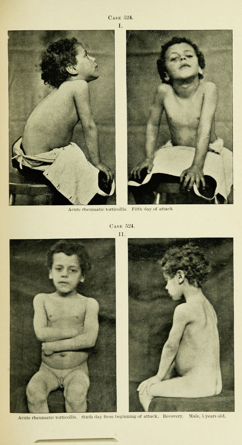 Acute rheumatic torticollis. Fifth day of attack Acute rheumatic torticollis. Sixth day from beginning of attack. Recovery. Male, 5 years old.