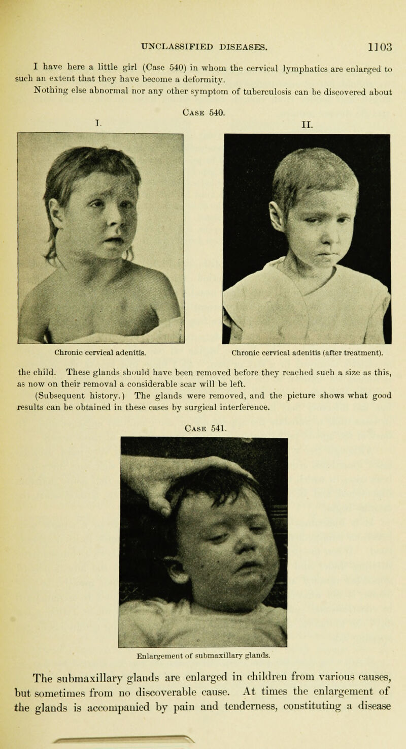 I have here a little girl (Case 540) in whom the cervical lymphatics are enlarged to such an extent that they have become a deformity. Nothing else abnormal nor any other symptom of tuberculosis can be discovered about Case 540. Chronic cervical adenitis. Chronic cervical adenitis (after treatment). the child. These glands should have been removed before they reached such a size as this, as now on their removal a considerable scar will be left. (Subsequent history.) The glands were removed, and the picture shows what good results can be obtained in these cases by surgical interference. Case 541. Enlargement of submaxillary glands. The submaxillary glauds are enlarged in children from various causes, but sometimes from no discoverable cause. At times the enlargement of the glands is accompanied by pain and tenderness, constituting a disease —\