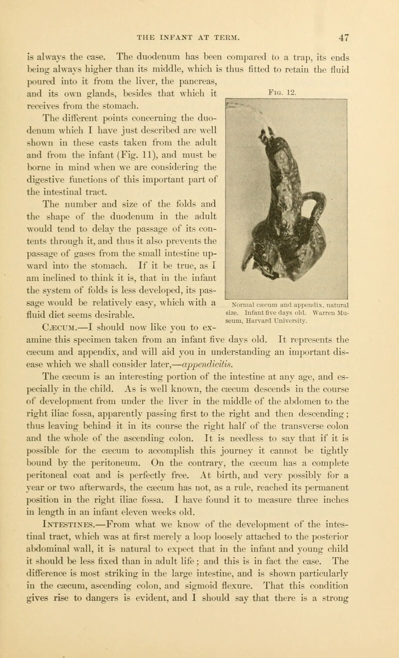 Fig. 12. mi*L mf<% 4«Sjr *••,. f ^•ifc '^ Normal ntoura and appendix, natural size. Infant five days old. Warren Mu- seum, Harvard University. is always the case. The duodenum has been compared to a trap, its ends being always higher than its middle, which is thus fitted to retain the fluid poured into it from the liver, the pancreas, and its own glands, besides that which it receives from the stomach. The different points concerning the duo- denum which I have just described are well shown in these casts taken from the adult and from the infant (Fig. 11), and must !><■ borne in mind when we are considering the digestive functions of this important part of the intestinal tract. The number and size of the folds and the shape of the duodenum in the adult would tend to delay the passage of its con- tents through it. and thus it also prevents the passage of gases from the small intestine up- ward into the stomach. If it be true, as I am inclined to think it is, that in the infant the system of folds is less developed, its pas- sage would be relatively easy, which with a fluid diet seems desirable. C-ECUM.—I should now like you to ex- amine this specimen taken from an infant five days old. It represents the caecum and appendix, and will aid you iu understanding an important dis- ease which we shall consider later,—appendicitis. The caecum is an interesting portion of the intestine at any age, and es- pecially iu the child. As is well known, the caecum descends in the course of development from under the liver in the middle of the abdomen to the right iliac fossa, apparently passing first to the right and then descending; thus leaving behind it in its course the right half of the transverse colon and the whole of the ascending colon. It is needless to say that if it is possible for the caecum to accomplish this journey it cannot be tightly bound by the peritoneum. On the contrary, the caecum has a complete peritoneal coat and is perfectly free. At birth, and very possibly for a year or two afterwards, the caecum has not, as a rule, reached its permanent position in the right iliac fossa. I have found it to measure three inches in length in an infant eleven weeks old. Intestines.—From what we know of the development of the intes- tinal tract, which was at first merely a loop loosely attached to the posterior abdominal wall, it is natural to expect that in the infant and young child it should be less fixed than in adult life; and this is in fact the case. The difference is most striking in the large intestine, and is shown particularly iu the caecum, ascending- colon, and sigmoid flexure. That this condition gives rise to dangers is evident, and I should say that there is a strong