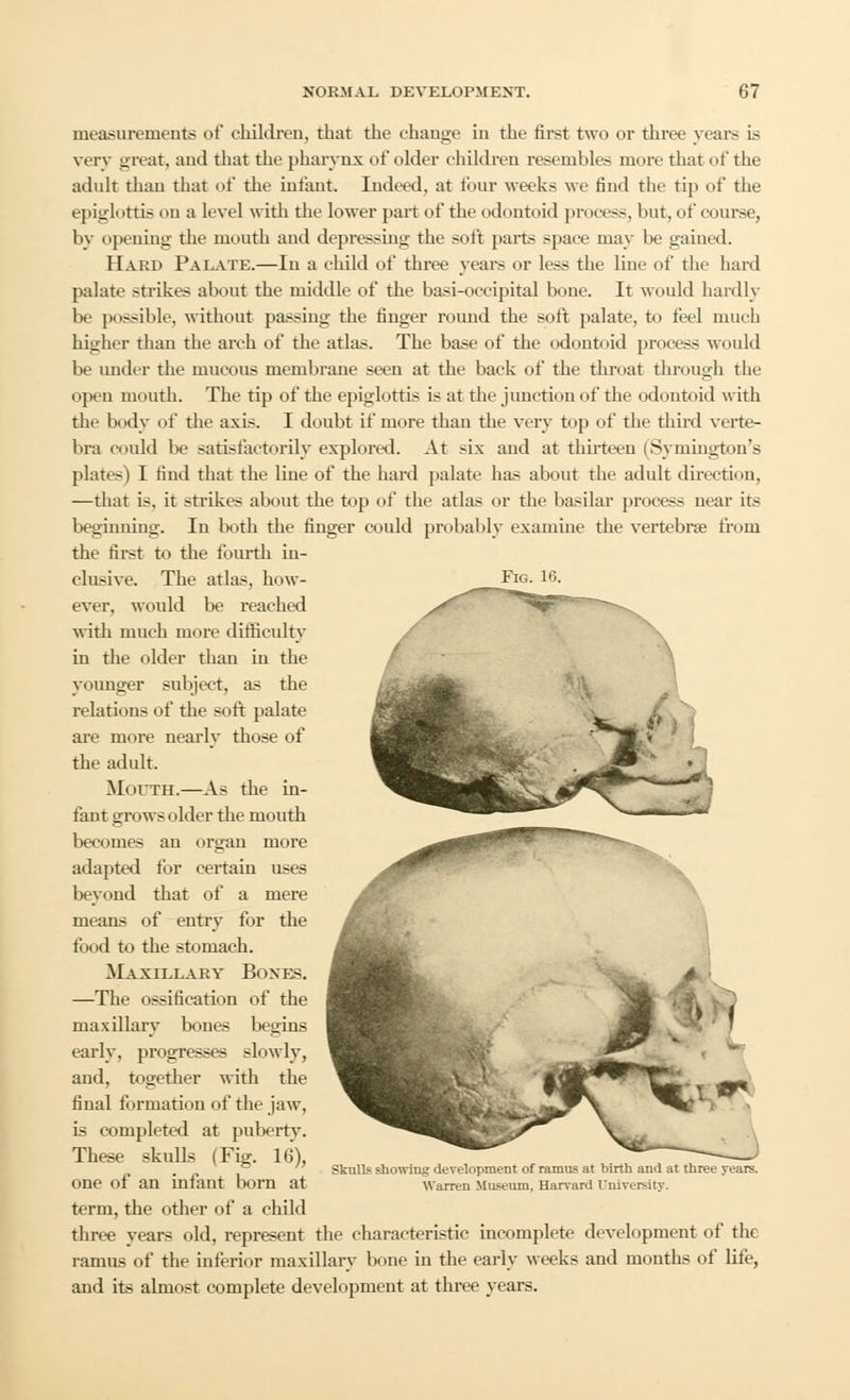 measurements of children, that the change in the first two or three years is very great, and that the pharynx of older children resembles more that of the adult than that of the infant. Indeed, at four weeks we find the tip of the epiglottis on a level with the lower part of the odontoid process, but, of course, by ii]idling the mouth and depressing the soft parts space may be gained. Hard Palate.—In a child of three years or less the line of the hard palate strikes about the middle of the basi-occipital bone. It would hardly be possible, without passing the finger round the soft palate, to feel much higher than the arch of the atlas. The base of the odontoid process would be under the mucous membrane seen at the back of the throat through the open mouth. The tip of the epiglottis is at the junction of the odontoid with the body of the axis. I doubt if more than the very top of the third verte- bra could be satisfactorily explored. At six and at thirteen (Symington's plates) I find that the line of the hard palate has about the adult direction, —that is. it strikes about the top of the atlas or the basilar process near its beginning. In both the finger could probably examine the vertebrae from the first to the fourth in- clusive. The atlas, how- Fig. i6- ever, would be reached ^ with much more difficulty / in the older than in the / younger subject, as the relations of the soft palate are more nearly those of the adult. Mouth.—As the in- fant grows older the mouth becomes an organ more adapted for certain uses beyond that of a mere means of entry for the food to the stomach. M axillary Boxes. —The ossification of the maxillary bones begins early, progresses slowly, and, together with the final formation of the jaw, is completed at puberty. These skulls (Fig. 16), one of an infant born at term, the other of a child three years old, represent the characteristic incomplete development of the ramus of the interior maxillary bone in the early weeks and months of life, and its almost complete development at three years. Skulls showing development of ramus at birth and at three years. Warren Museum, Harvard University.