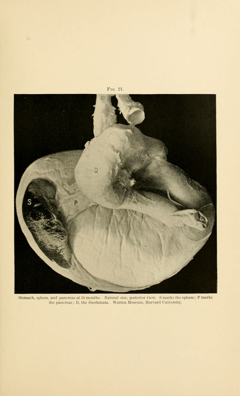 the pancreas; D, the duodenum. Warren Museum, Harvard University.