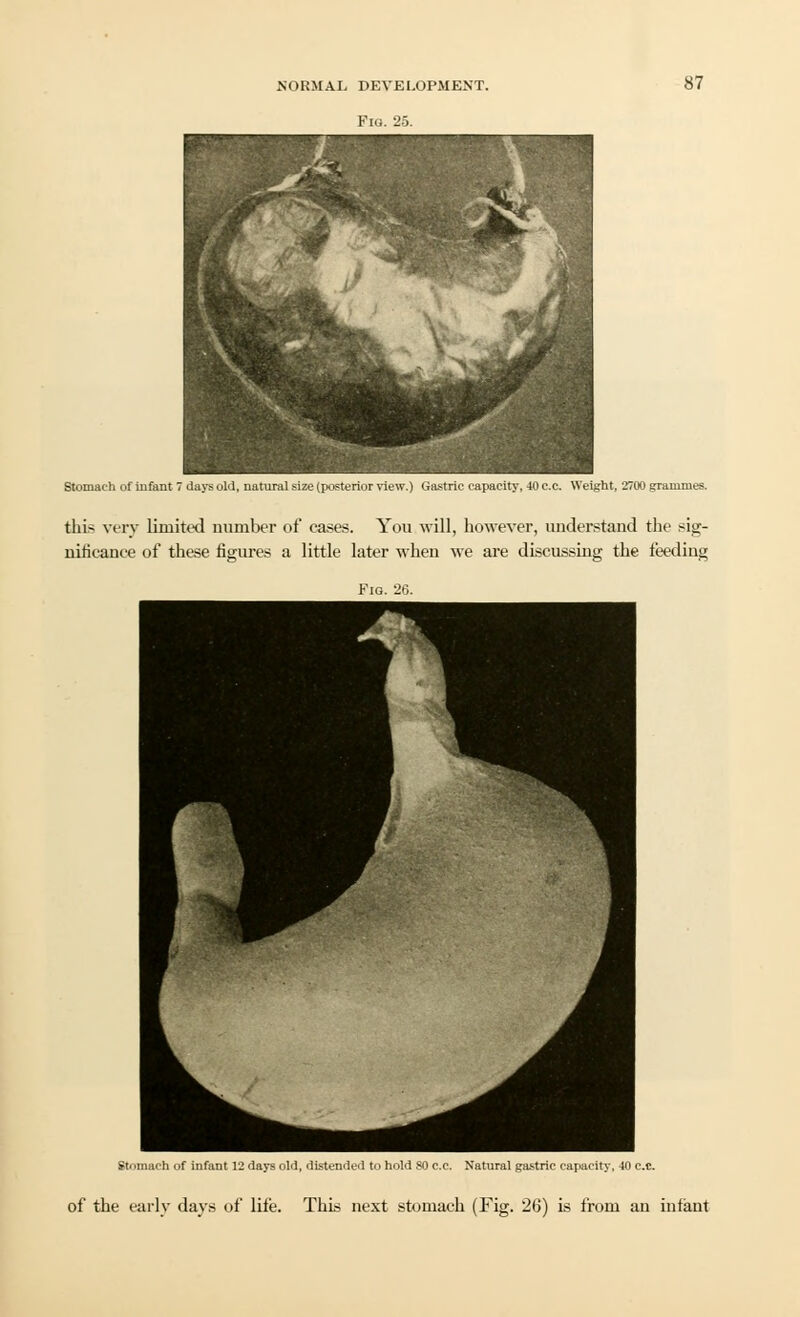 Flo. 25. 87 VjjjB ' ™S! ^P(F* ^^P*^^ Stomach of infant 7 days old, natural size (posterior view.) Gastric capacity, 40 c.c. Weight, 2700 grammes. this very limited number of cases. You will, however, understand the sig- nificance of these figures a little later when we are discussing the feeding Fio. 26. Stomach of infant 12 days old, distended to hold 80 c.c. Natural gastric capacity, 40 c.c.
