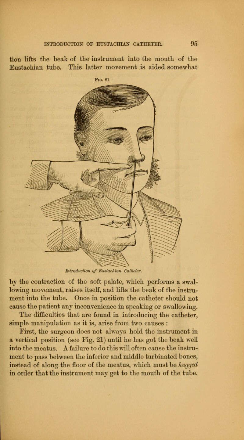 tion lifts the beak of the instrument into the mouth of the Eustachian tube. This latter movement is aided somewhat Fig. 21. Introduction of Eustachian Catheter. by the contraction of the soft palate, which performs a swal- lowing movement, raises itself, and lifts the beak of the instru- ment into the tube. Once in position the catheter should not cause the patient any inconvenience in speaking or swallowing. The difficulties that are found in introducing the catheter, simple manipulation as it is, arise from two causes : First, the surgeon does not always hold the instrument in a vertical position (see Fig. 21) until he has got the beak well into the meatus. A failure to do this will often cause the instru- ment to pass between the inferior and middle turbinated bones, instead of along the floor of the meatus, which must be hugged in order that the instrument may get to the mouth of the tube.