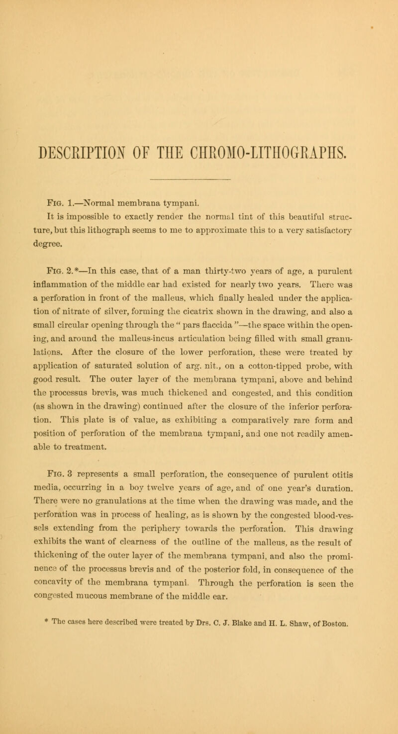 DESCRIPTION OF THE CHROMO-IITHOGRAPHS. Fig. 1.—Normal membrana tympani. It is impossible to exactly render the normal tint of tliis beautiful struc- ture, but this lithograph seems to me to approximate this to a very satisfactory degree. Fig. 2.*—In this case, that of a man thirty-two years of age, a purulent inflammation of the middle ear had existed for nearly two years. There was a perforation in front of the malleus, which finally healed under the applica- tion of nitrate of silver, forming the cicatrix shown in the drawing, and also a small circular opening through the  pars flaccida —the space within the open- ing, and around the malleus-incus articulation being filled with small granu- lations. After the closure of the lower perforation, these were treated by application of saturated solution of arg. nit., on a cotton-tipped probe, with good result. The outer layer of the membrana tjTupani, above and behind the processus brevis, was much thickened and congested, and this condition (as shown in the drawing) continued after the closure of the inferior perfora- tion. This plate is of value, as exhibiting a comparatively rare form and position of perforation of the membrana tympani, and one not readily amen- able to treatment. Fig. 3 represents a small perforation, the consequence of purulent otitis media, occurring in a boy twelve years of age, and of one year's duration. There were no granulations at the time when the drawing was made, and the perforation was in process of healing, as is shown by the congested blood-ves- sels extending from the periphery towards the perforation. This drawing exhibits the want of clearness of the outline of the malleus, as the result of thickening of the outer layer of the membrana tympani, and also the promi- nence of the processus brevis and of the posterior fold, in consequence of the concavity of the membrana tympani. Through the perforation is seen the congested mucous membrane of the middle ear. * The cases here described were treated by Drs. C. J. Blake and H. L. Shaw, of Boston.