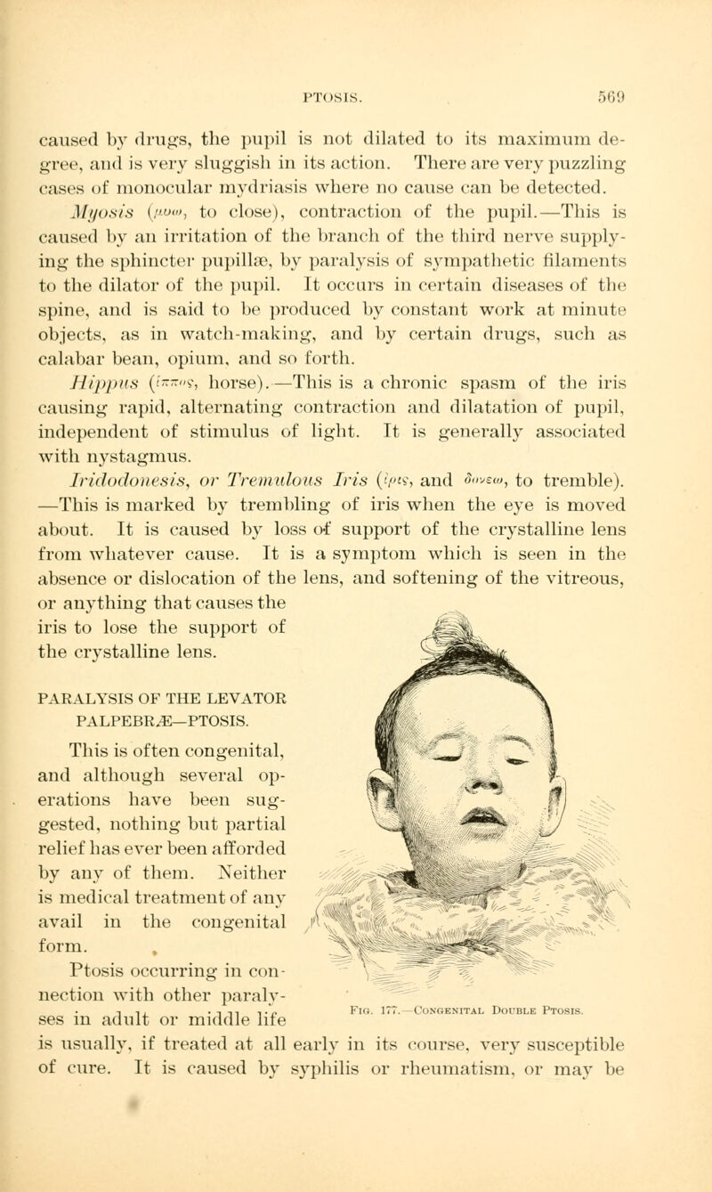 caused hy drugs, the pupil is not dilated to its maximum de- gree, and is very sluggish in its action. There are very puzzling cases of monocular mydriasis where no cause can be detected. Myosis (,«<, to close), contraction of the pupil.—This is caused by an irritation of the branch of the third nerve supply- ing the sphincter pupillse, by paralysis of sympathetic filaments to the dilator of the pupil. It occurs in certain diseases of the spine, and is said to be produced by constant work at minute objects, as in watch-making, and by certain drugs, such as calabar bean, opium, and so forth. Hippus (t»9, horse).—This is a chronic spasm of the iris causing rapid, alternating contraction and dilatation of pupil, independent of stimulus of light. It is generally associated with nystagmus. Iridodonesis, or Tremulous Iris (?pi$, and Sovea>, to tremble). —This is marked by trembling of iris when the eye is moved about. It is caused by loss of support of the crystalline lens from whatever cause. It is a symptom which is seen in the absence or dislocation of the lens, and softening of the vitreous, or anything that causes the iris to lose the support of the crystalline lens. PARALYSIS OF THE LEVATOR PALPEBR^—PTOSIS. This is often congenital, and although several op- erations have been sug- gested, nothing but partial relief has ever been afforded by any of them. Neither is medical treatment of any avail in the congenital form. , Ptosis occurring in con- nection with other paraly- ses in adult or middle life is usually, if treated at all early in its course, very susceptible of cure. It is caused by syphilis or rheumatism, or may be i^«^ *<^ Congenital Double Ptosis.
