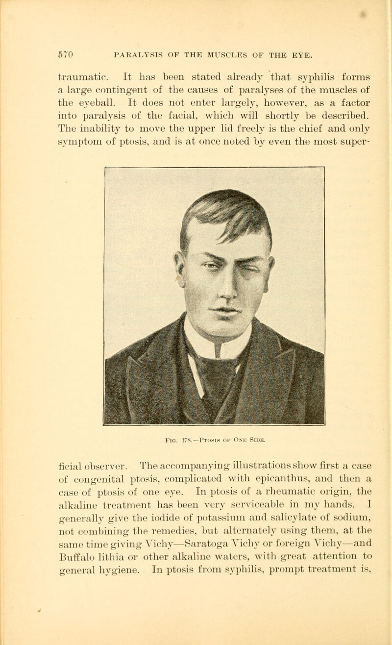 traumatic. It has been stated already that syphilis forms a large contingent of the causes of paralyses of the muscles of the eyeball. It does not enter largely, however, as a factor into paralysis of the facial, which will shortly be described. The inability to move the upper lid freely is the chief and only symptom of ptosis, and is at once noted by even the most super- Fig. 178.—Ptosis of One Side. ficial observer. The accompanying illustrations show first a case of congenital ptosis, complicated with epicanthus, and then a case of ptosis of one eye. In ptosis of a rheumatic origin, the alkaline treatment has been very serviceable in my hands. I generally give the iodide of potassium and salicylate of sodium, not combining the remedies, but alternately using them, at the same time giving Vichy—Saratoga Vichy or foreign Vichy—and Buffalo lithia or other alkaline waters, with great attention to general hygiene. In ptosis from syphilis, prompt treatment is.