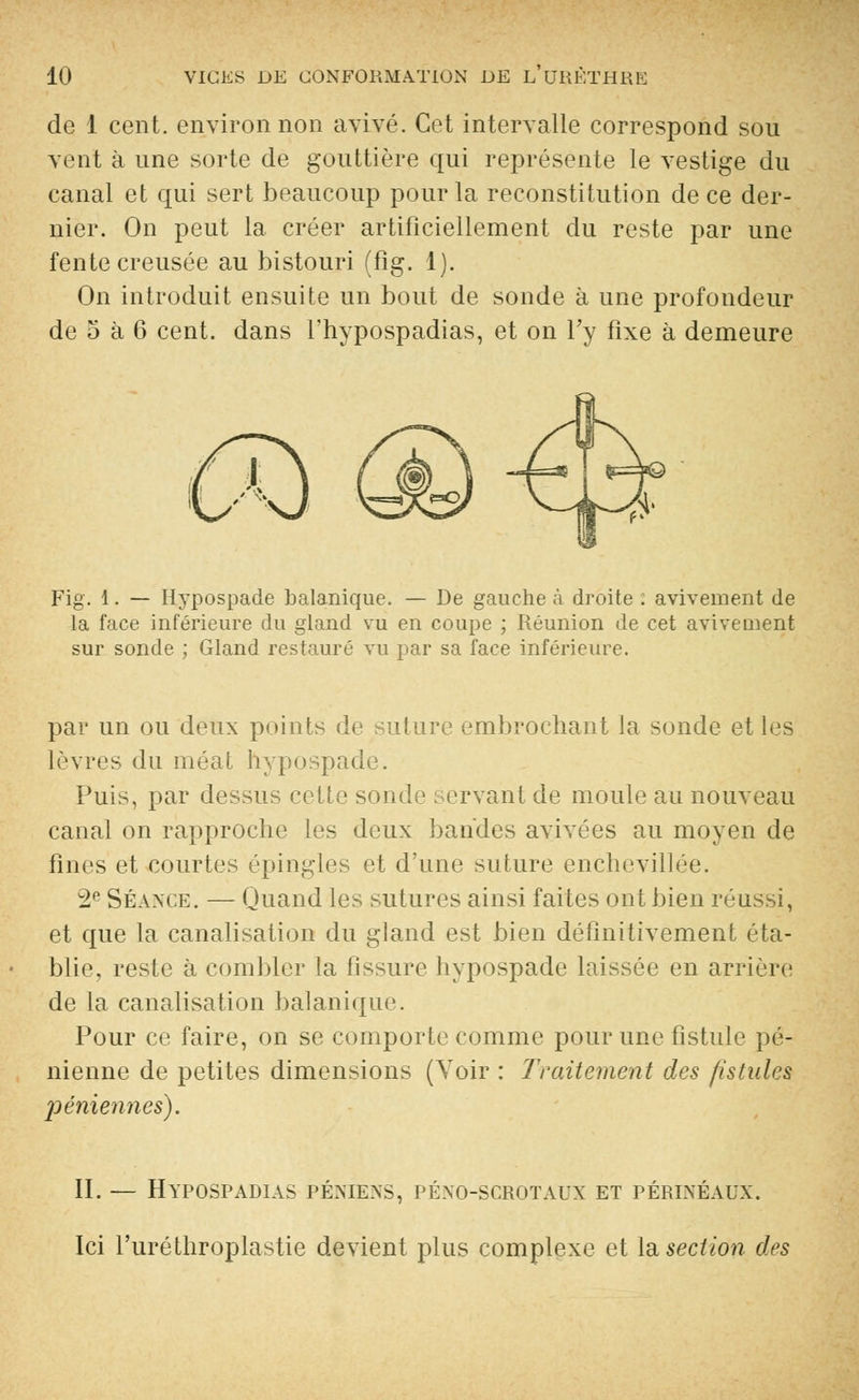 de 1 cent, environ non avivé. Cet intervalle correspond sou vent à une sorte de gouttière qui représente le vestige du canal et qui sert beaucoup pour la reconstitution de ce der- nier. On peut la créer artificiellement du reste par une fente creusée au bistouri (fig. 1). On introduit ensuite un bout de sonde à une profondeur de 5 à 6 cent, dans l'hypospadias, et on l'y fixe à demeure Fig. 1. — Hypospade balanique. — De gauche à droite ; aviveraient de la face inférieure du gland vu en coupe ; Réunion de cet avive aient sur sonde ; Gland restauré vu par sa face inférieure. par un ou deux points de suture embrochant la sonde et les lèvres du méat hypospade. Puis, par dessus cette sonde servant de moule au nouveau canal on rapproche les deux bandes avivées au moyen de fines et courtes épingles et d'une suture enchevillée. 2e Séance. — Quand les sutures ainsi faites ont bien réussi, et que la canalisation du gland est bien définitivement éta- blie, reste à combler la fissure hypospade laissée en arrière de la canalisation balanique. Pour ce faire, on se comporte comme pour une fistule pé- nienne de petites dimensions (Voir : Traitement des fistules péniennes). II. — Hypospadias péniens, péno-scrotaux et périnéaux. Ici l'uréthroplastie devient plus complexe et la section des