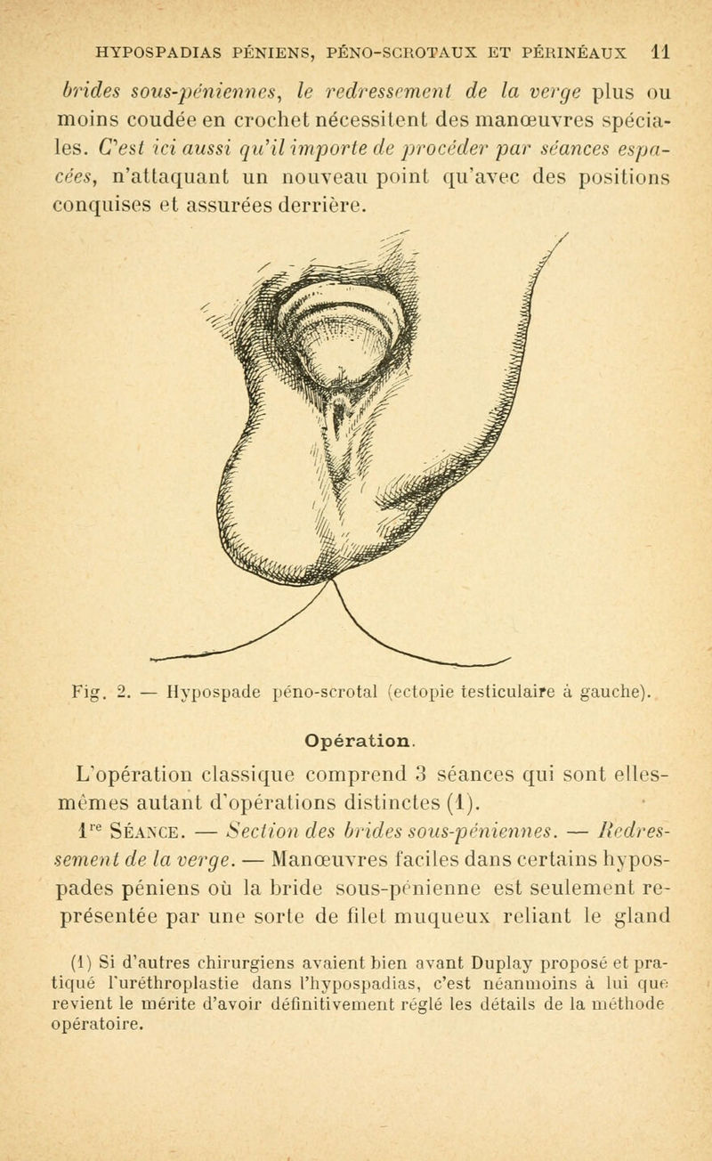 brides sous-péniennes, le redressement de la verge plus ou moins coudée en crochet nécessitent des manœuvres spécia- les. Cest ici aussi qu'il importe de procéder par séances espa- cées, n'attaquant un nouveau point qu'avec des positions conquises et assurées derrière. Fig. 2. — Hypospade péno-scrotal (ectopie testiculaire à gauche). Opération. L'opération classique comprend 3 séances qui sont elles- mêmes autant d'opérations distinctes (1). lre Séance. — Section des brides sous-péniennes. — Redres- sement de la verge. — Manœuvres faciles dans certains hypos- pades péniens où la bride sous-pénienne est seulement re- présentée par une sorte de filet muqueux reliant le gland (1) Si d'autres chirurgiens avaient bien avant Duplay proposé et pra- tiqué Furéthroplastie dans l'hypospadias, c'est néanmoins à lui que revient le mérite d'avoir définitivement réglé les détails de la méthode opératoire.