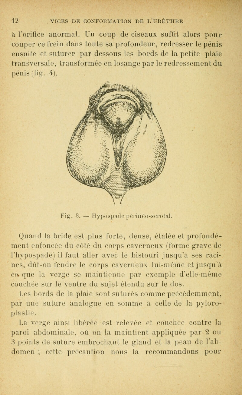 à l'orifice anormal. Un coup de ciseaux suffit alors pour couper ce frein dans toute sa profondeur, redresser le pénis ensuite et suturer par dessous les bords de la petite plaie transversale, transformée en losange par le redressement du pénis (fig. 4). Fig. 3. — Hypospade périnéo-scrotal. Quand la bride est plus forte, dense, étalée et profondé- ment enfoncée du côté du corps caverneux (forme grave de l'hypospade) il faut aller avec le bistouri jusqu'à ses raci- nes, dut-on fendre le corps caverneux lui-même et jusqu'à ce* que la verge se maintienne par exemple d'elle-même couchée sur le ventre du sujet étendu sur le dos. Les bords de la plaie sont suturés comme précédemment, par une suture analogue en somme à celle de la pyloro- plastie. La verge ainsi libérée est relevée et couchée contre la paroi abdominale, où on la maintient appliquée par 2 ou 3 points de suture embrochant le gland et la peau de l'ab- domen ; cette précaution nous la recommandons pour